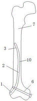 Elastic intramedullary nail with functions of pressurizing and resisting rotation