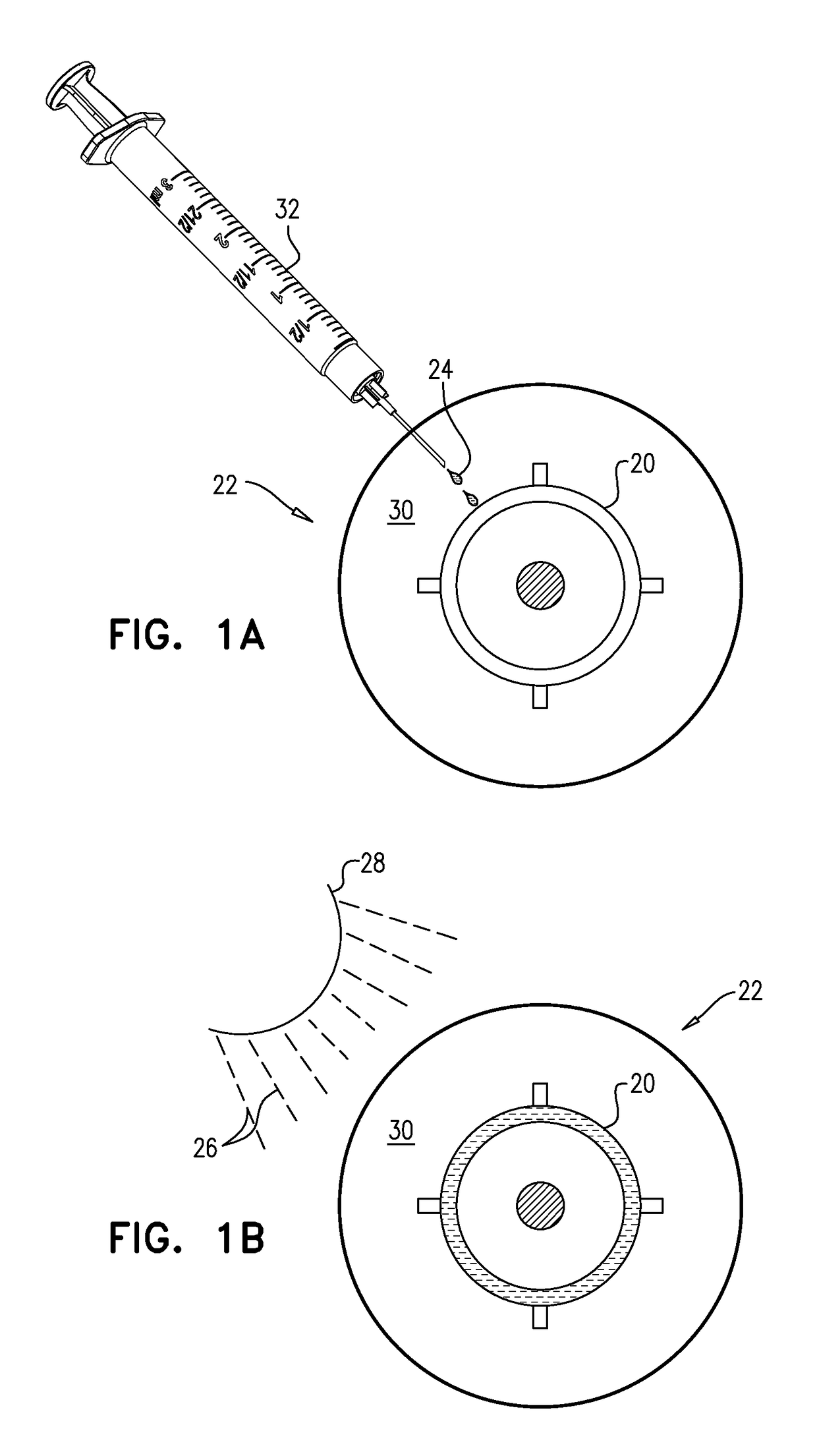 Eye implant