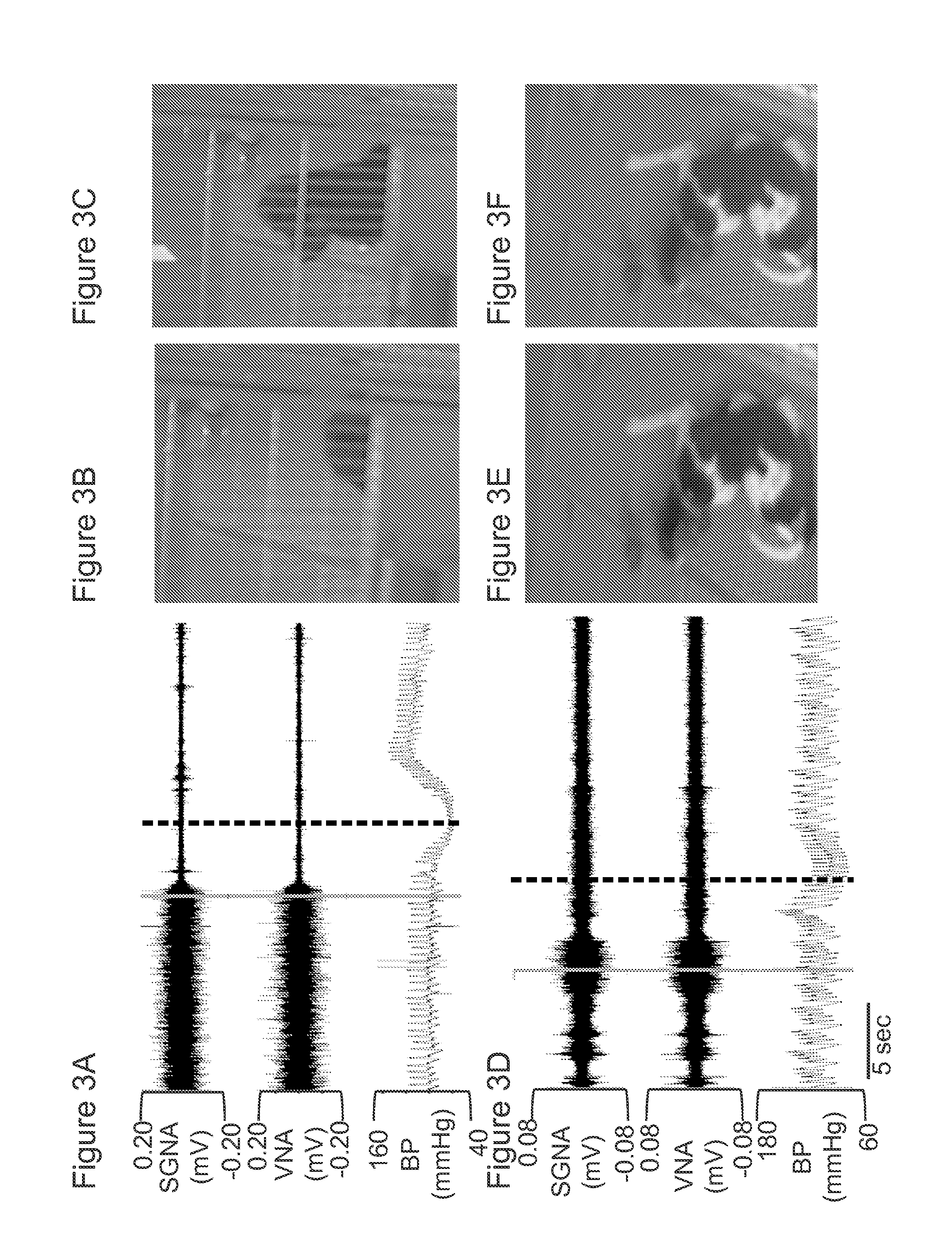 Beta 2 adrenoceptor antagonists for treating orthostatic hypotension