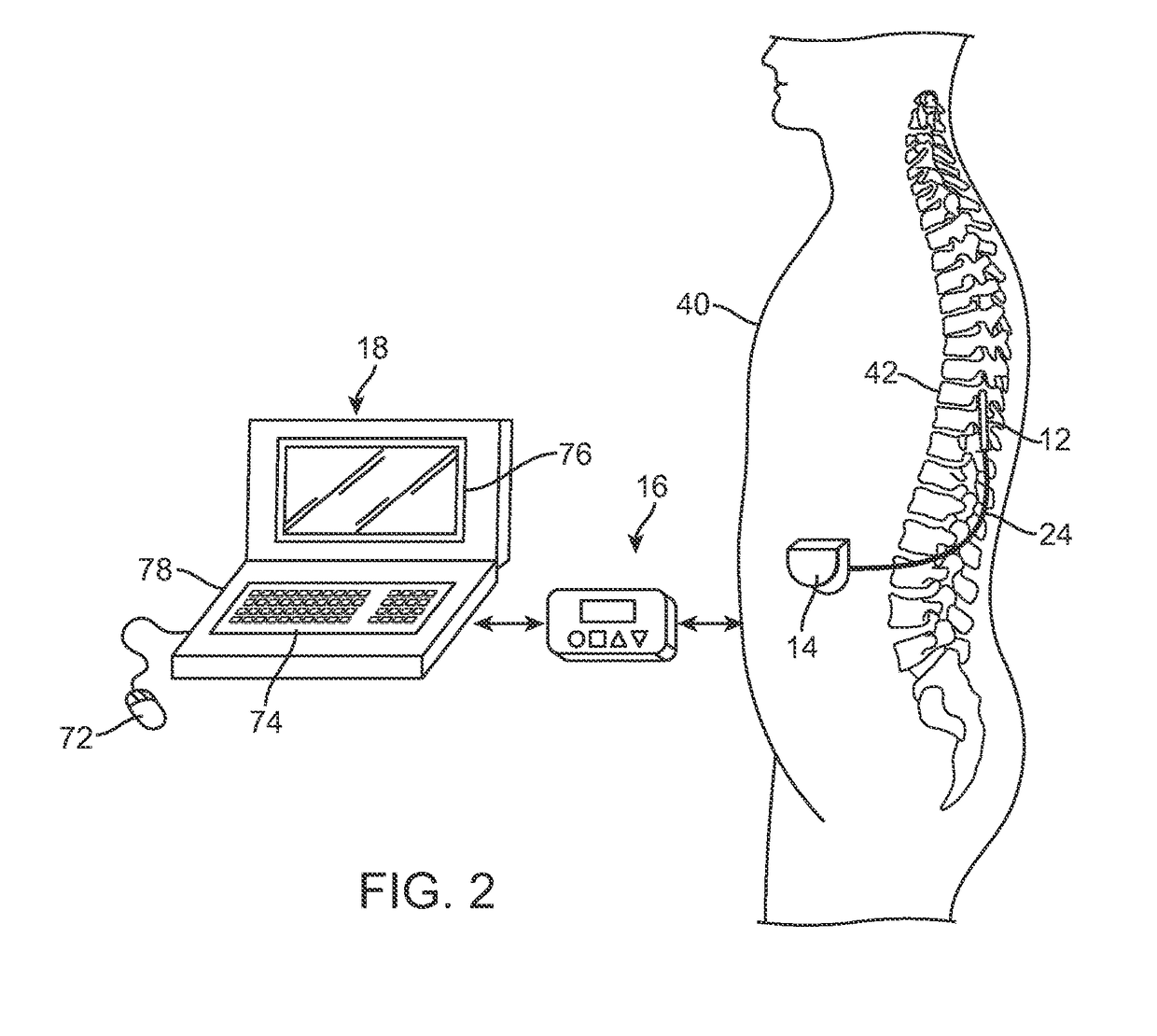 Systems and methods for programming a neuromodulation system