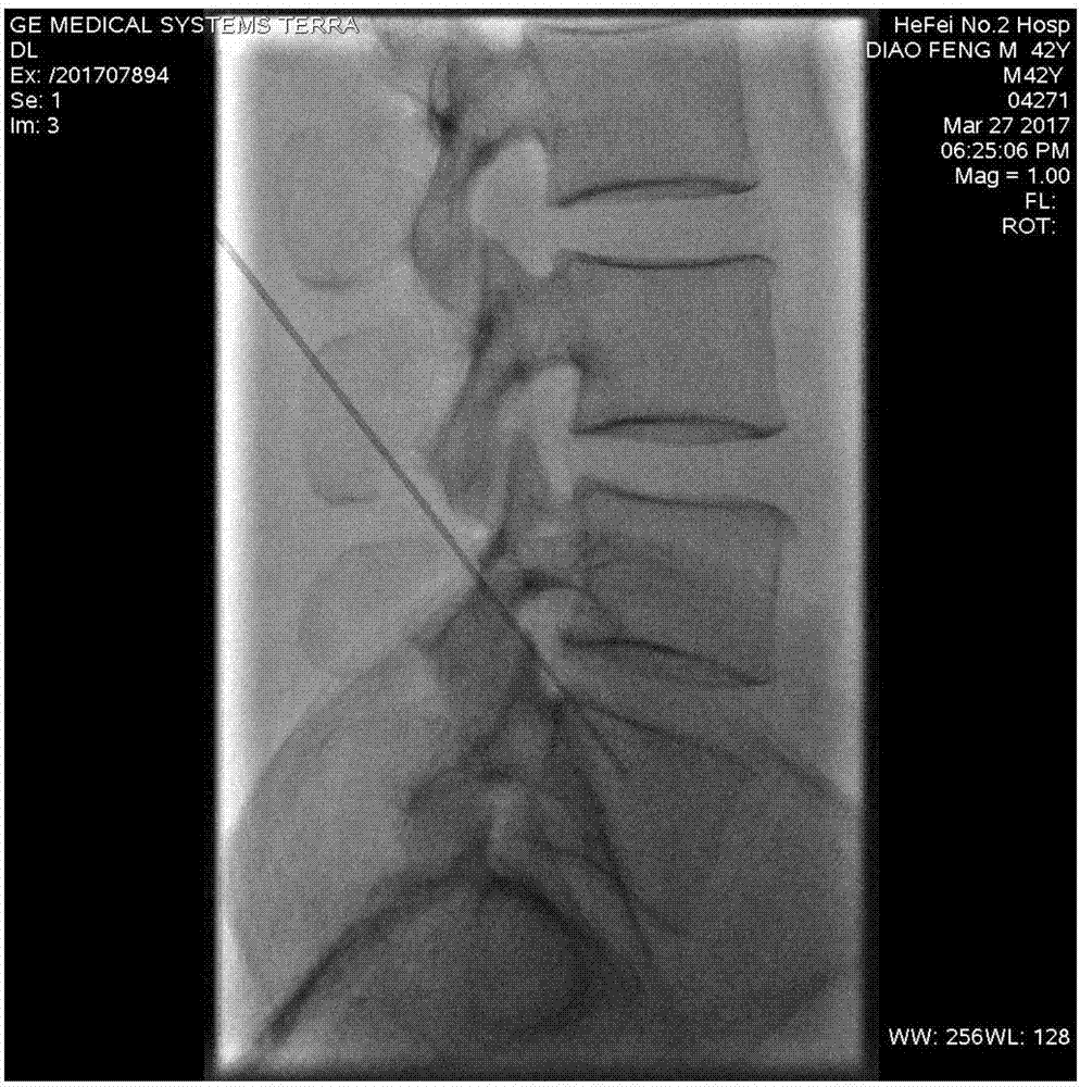 Transforaminal endoscope operation positioning method based on X-ray machine