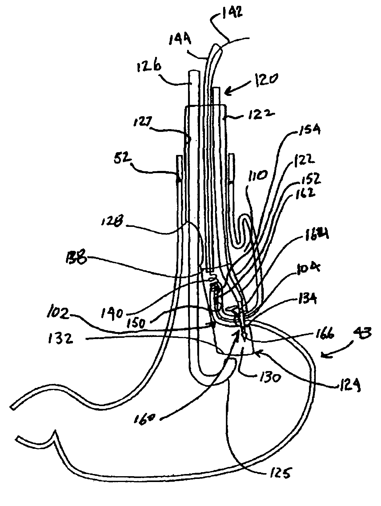 Transesophageal gastric reduction method and device for reducing the size of a previously formed gastric reduction pouch