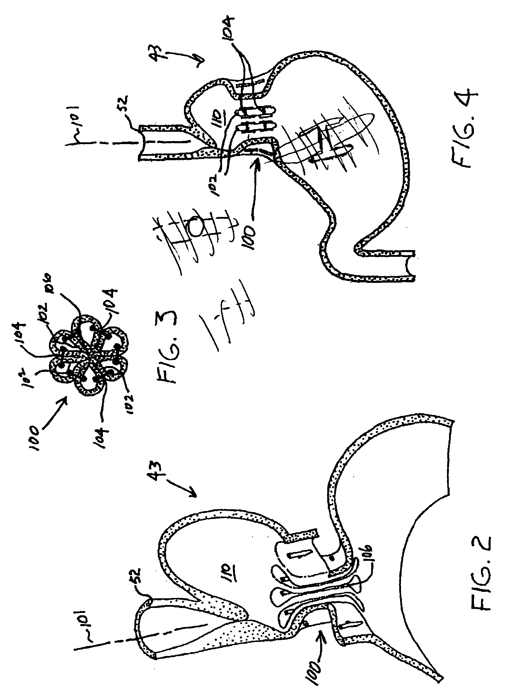 Transesophageal gastric reduction method and device for reducing the size of a previously formed gastric reduction pouch