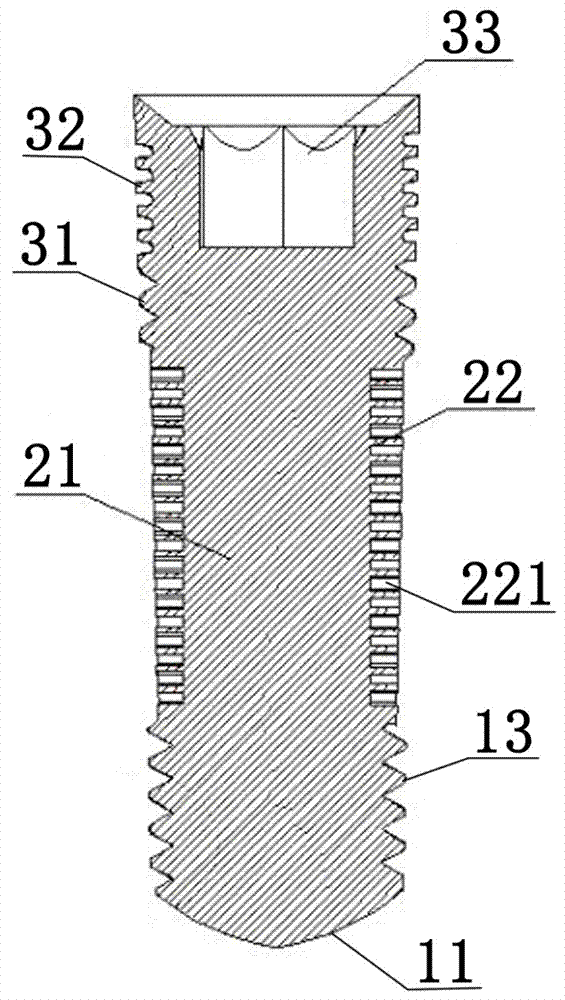 3D printed fang implant with multisection structure