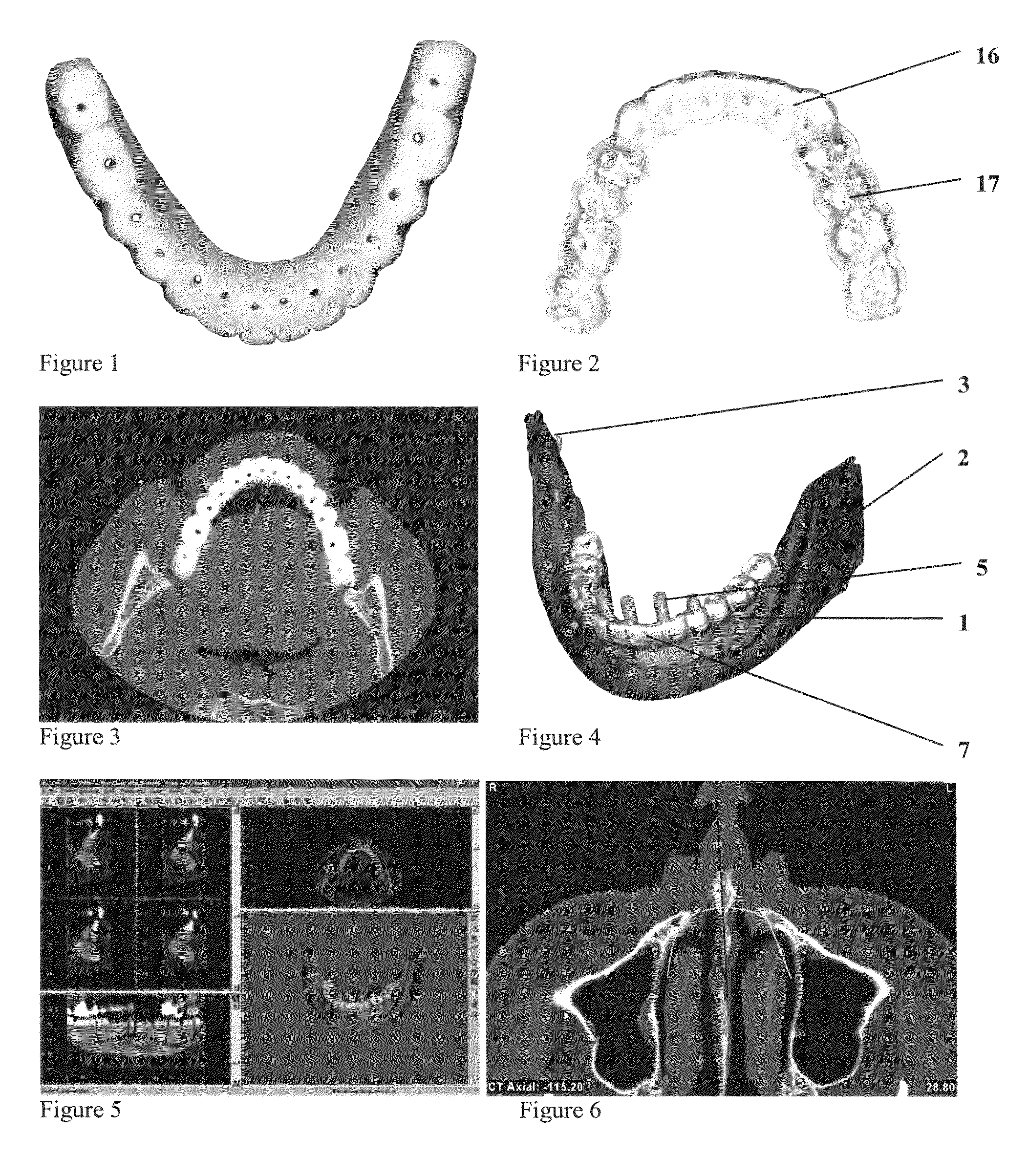 Method for (semi-) automatic dental implant planning