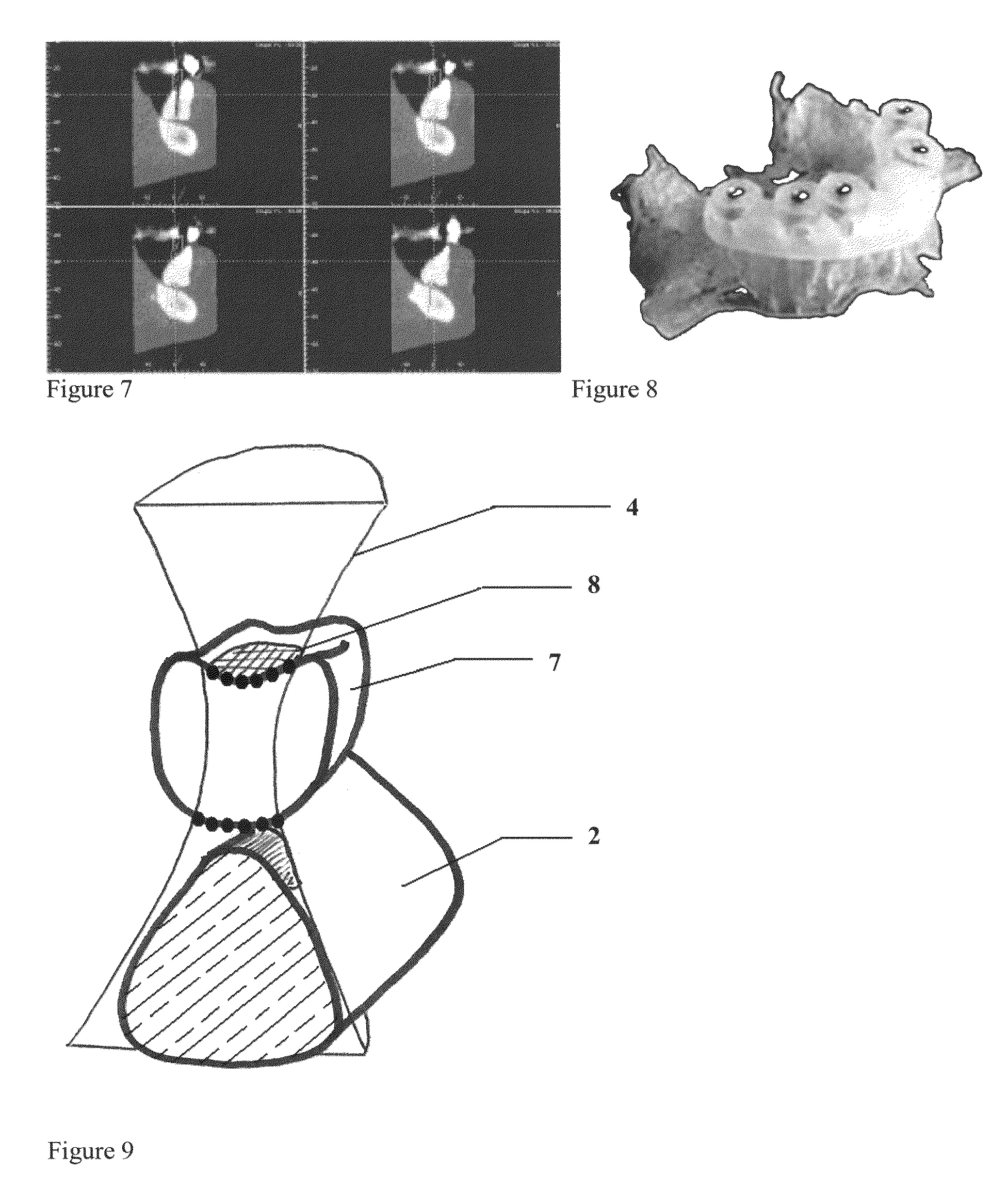 Method for (semi-) automatic dental implant planning