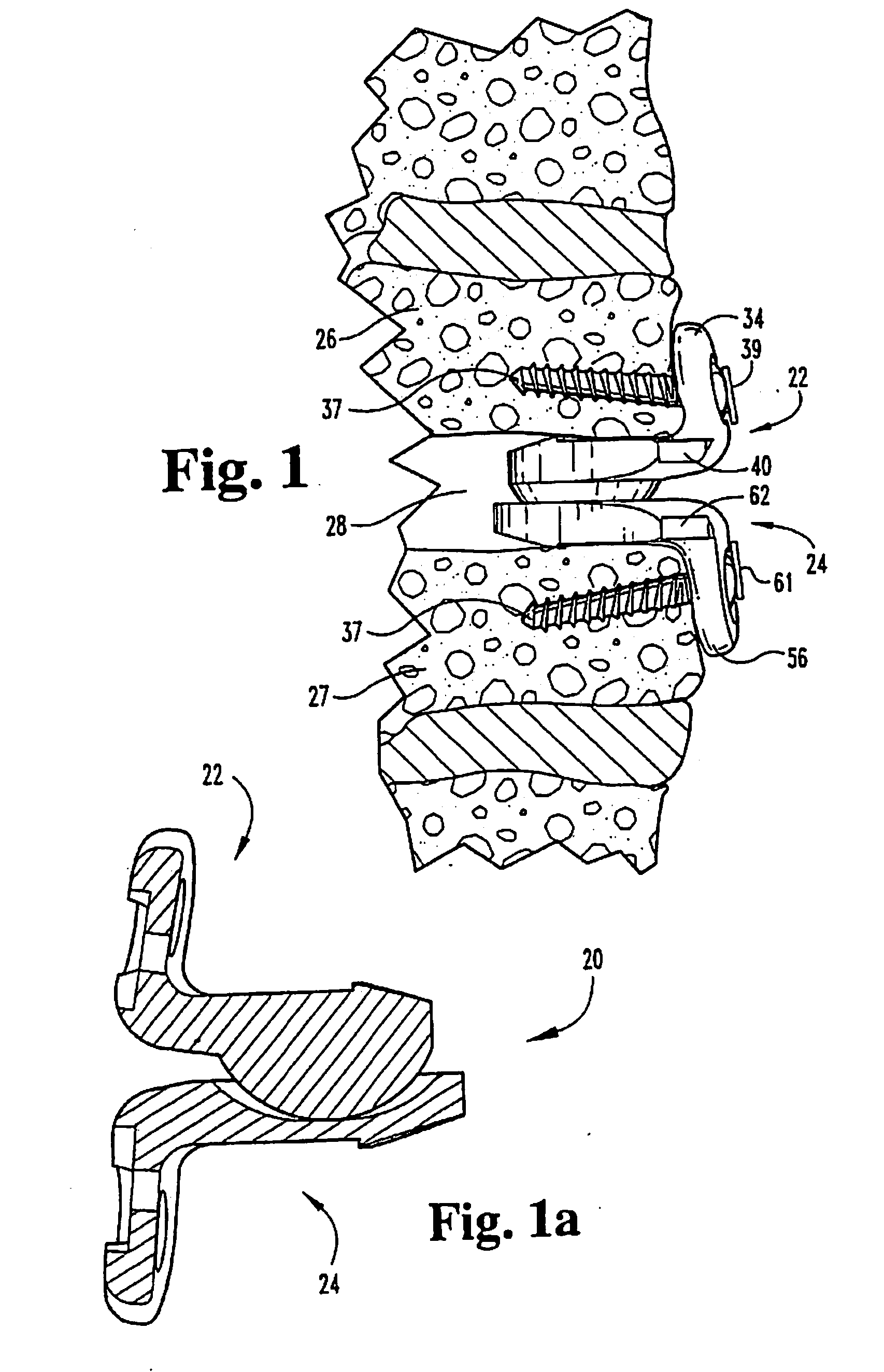 Artificial Intervertebral Joint Permitting Translational and Rotational Motion