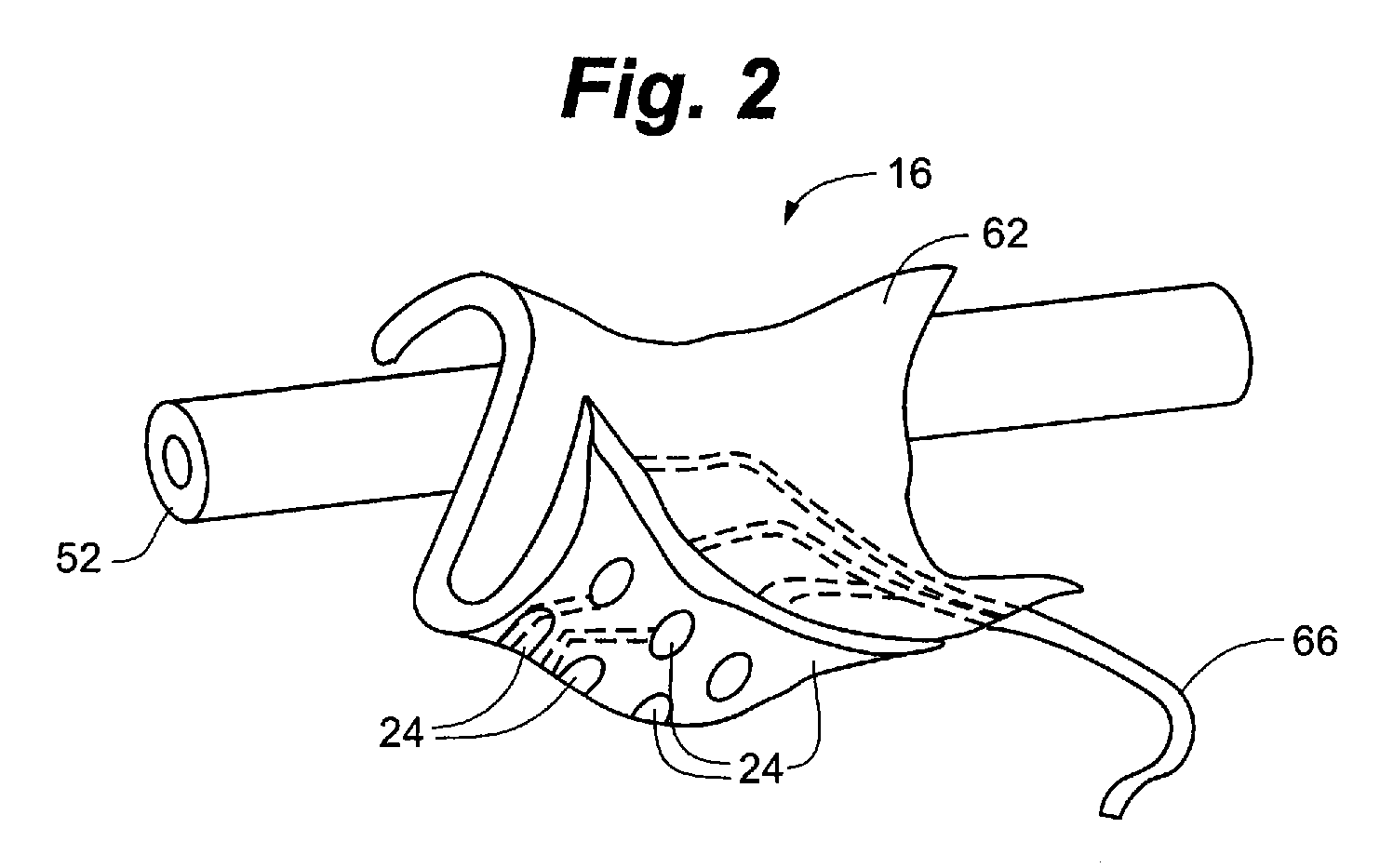 Method and system for implantable pressure transducer for regulating blood pressure