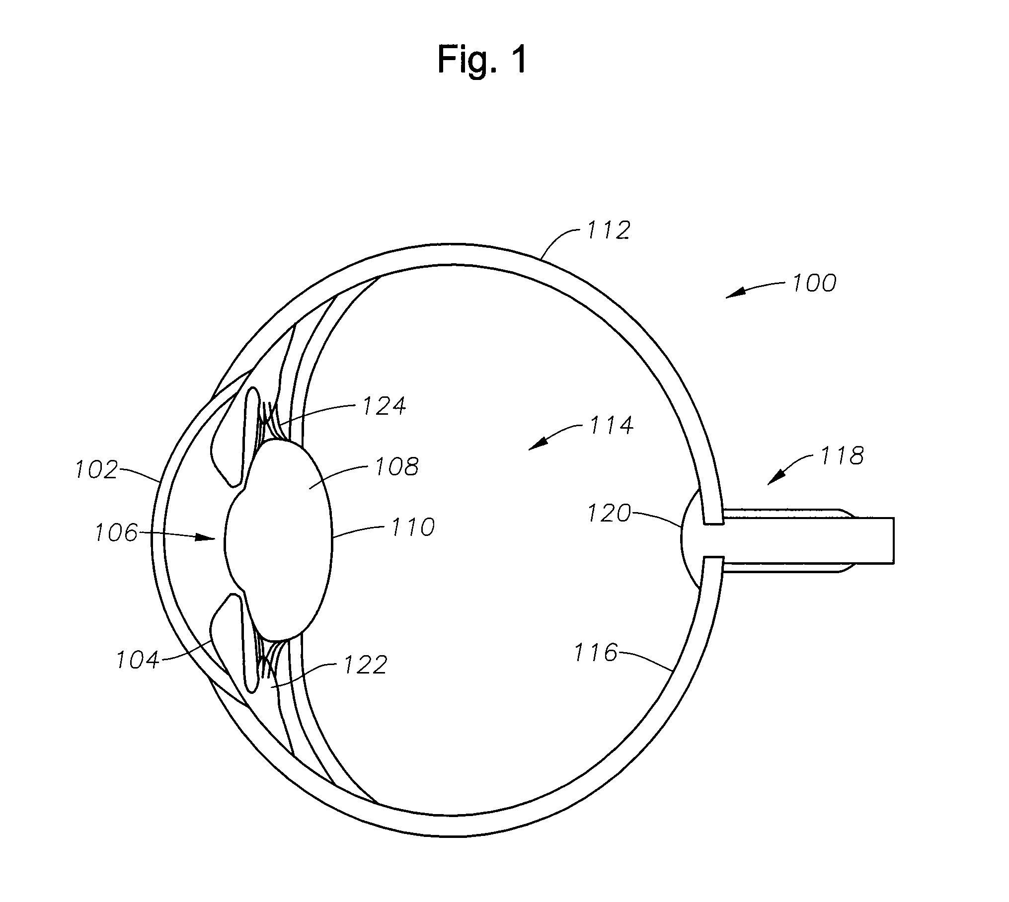 Radially segmented apodized diffractive multifocal design for ocular implant