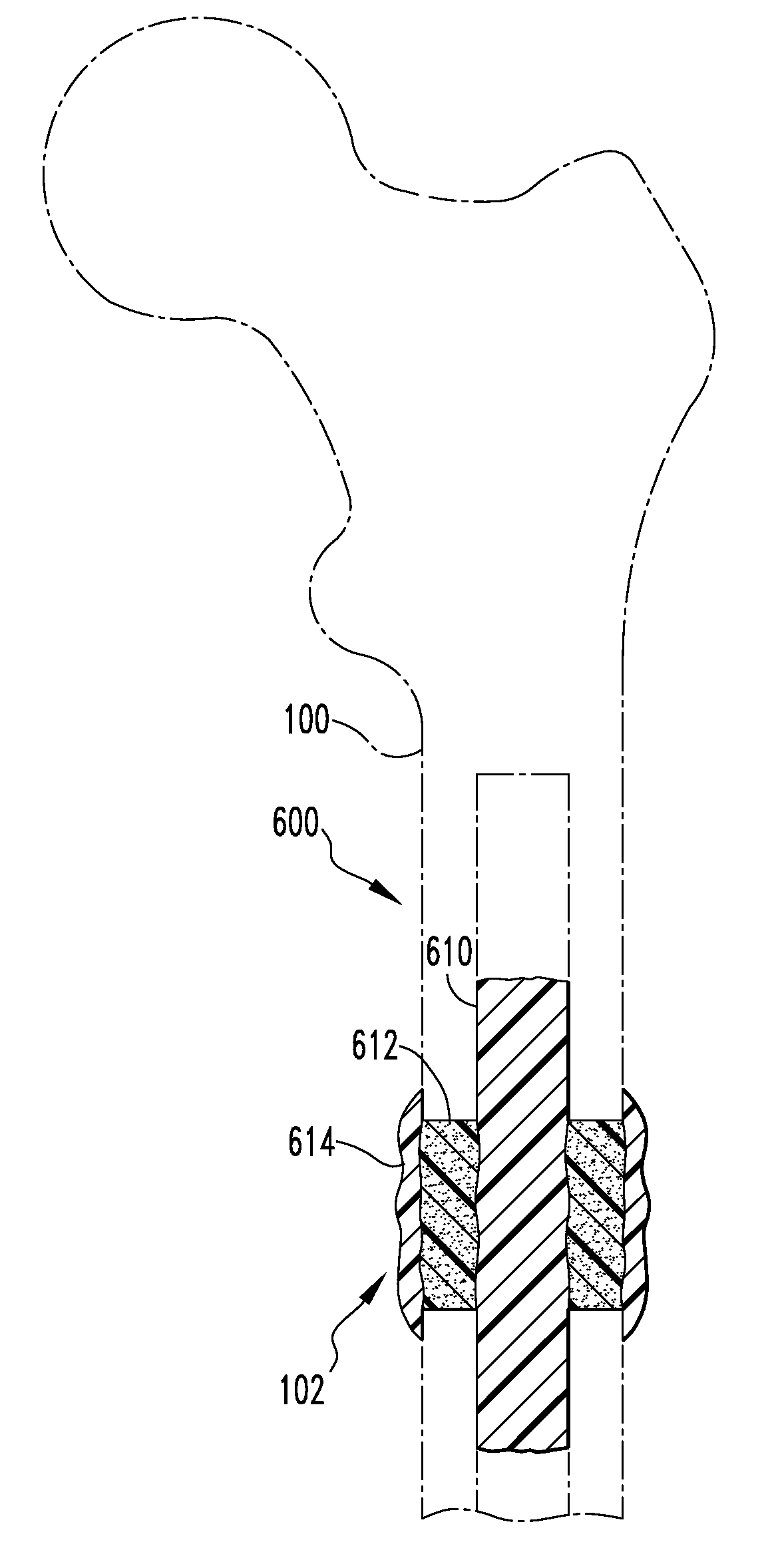 Fracture fixation systems