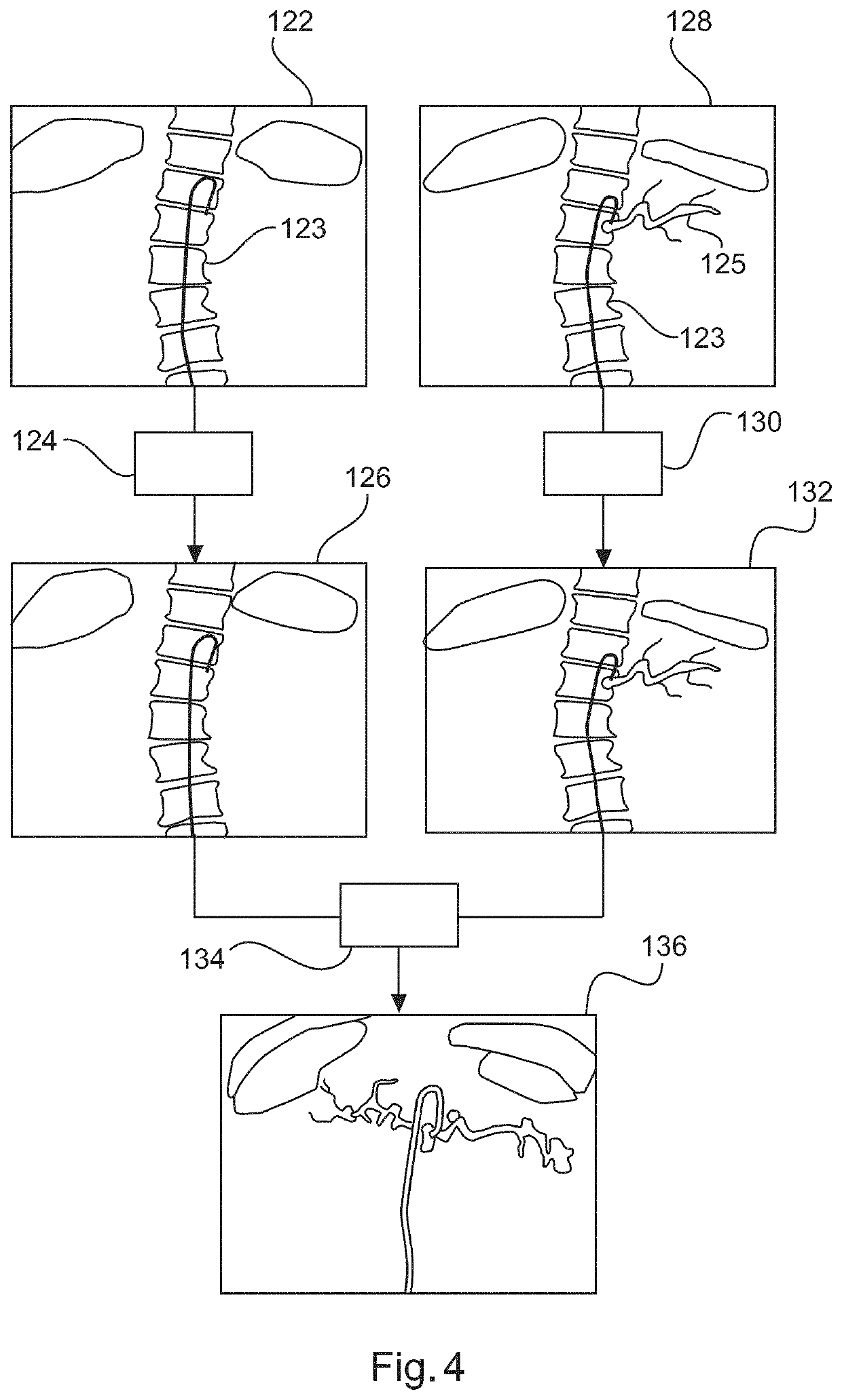 Visualizing vascular structures