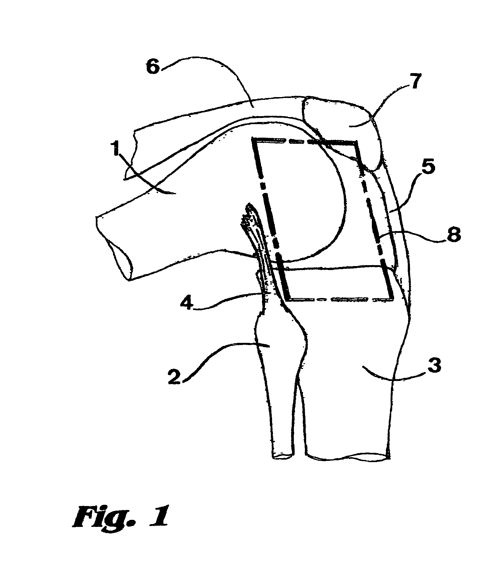 Bicondylar resurfacing prosthesis and method for insertion through direct lateral approach