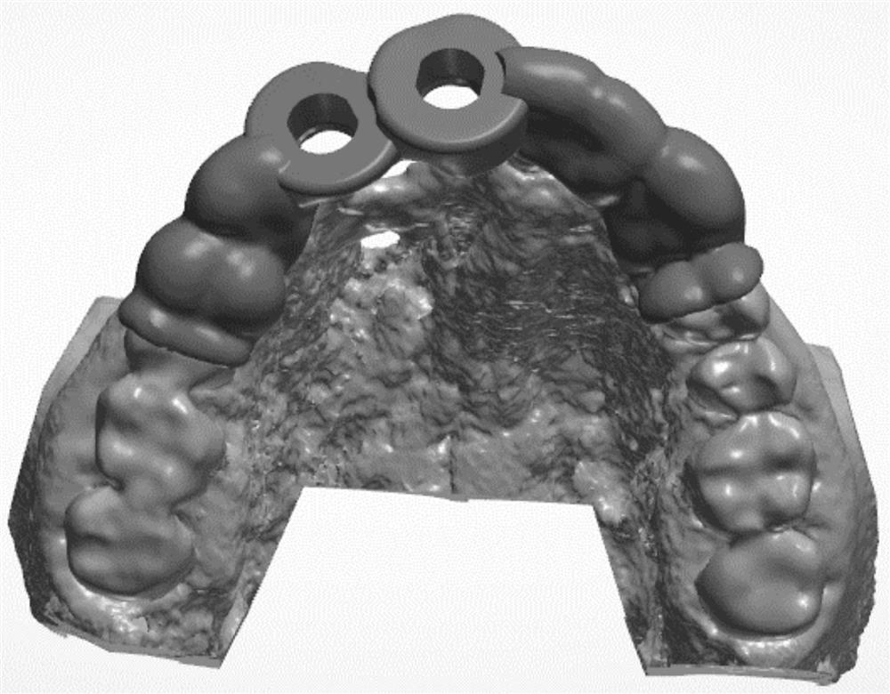 Combined design method of bone increment and implant denture and manufacturing method of bone increment model