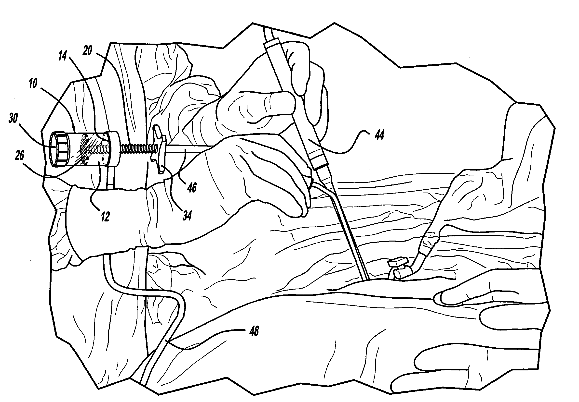 Device for collecting bone material during a surgical procedure