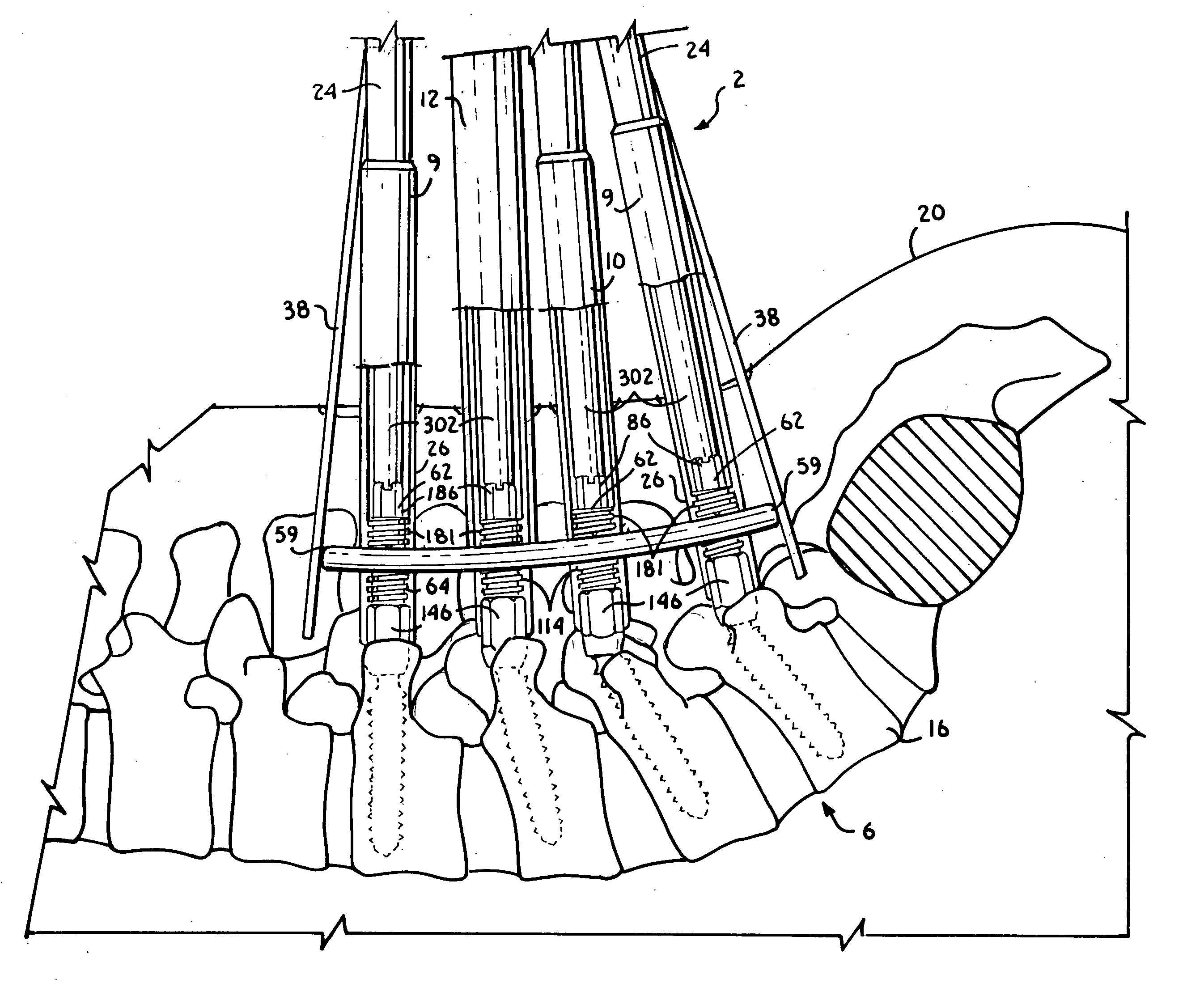 Spinal fixation tool set and method