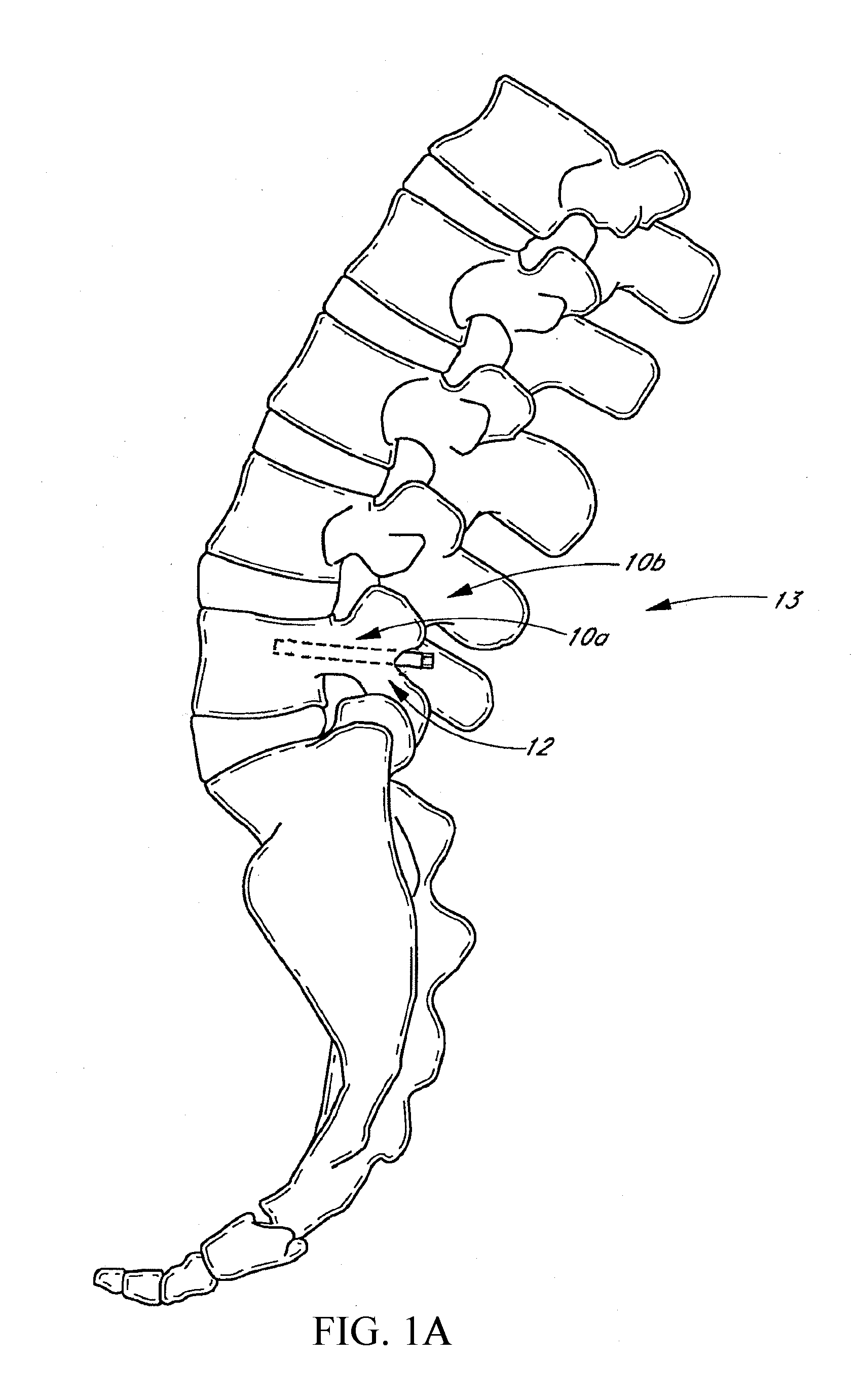 Method and apparatus for spinal stabilization