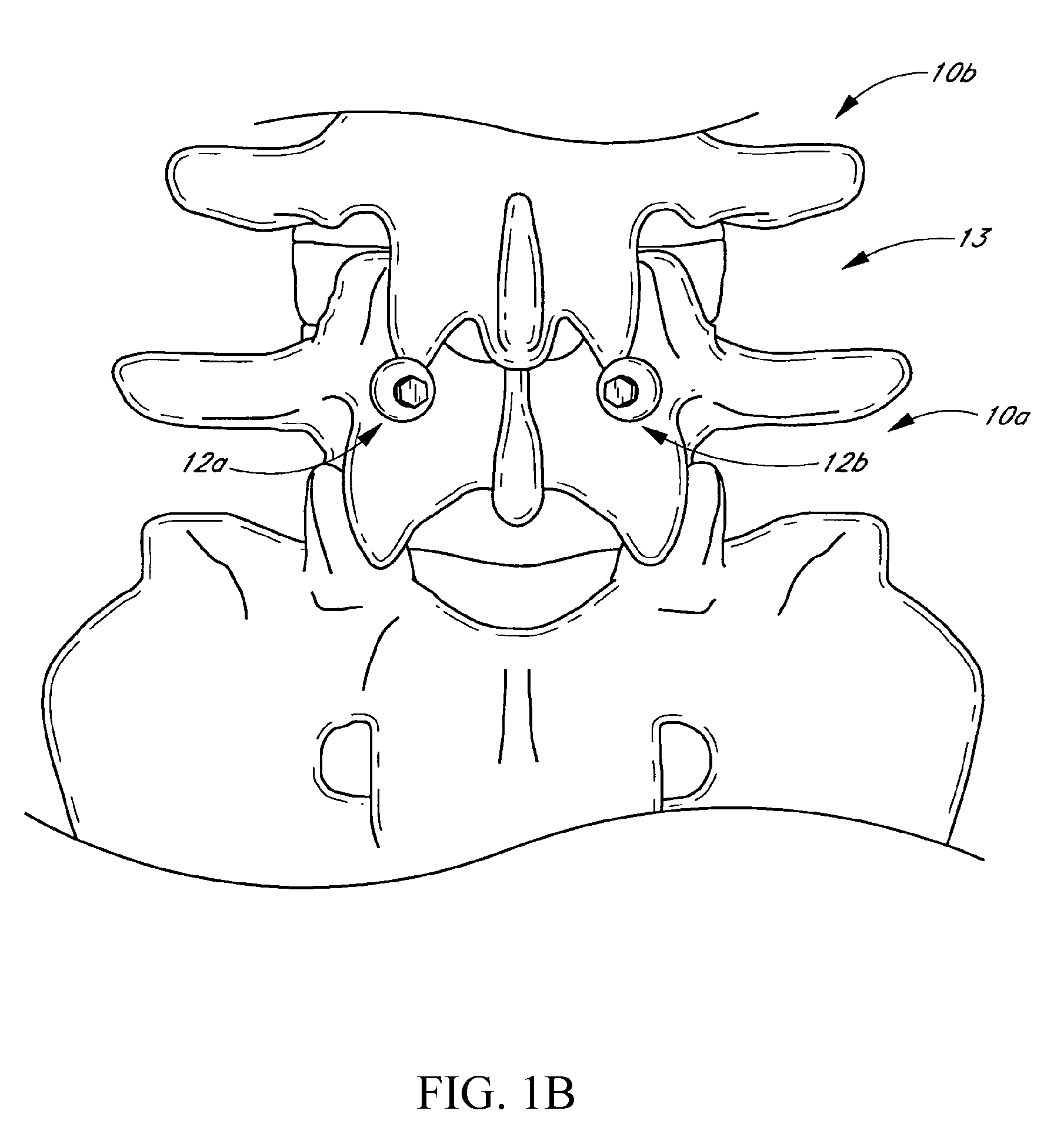 Method and apparatus for spinal stabilization