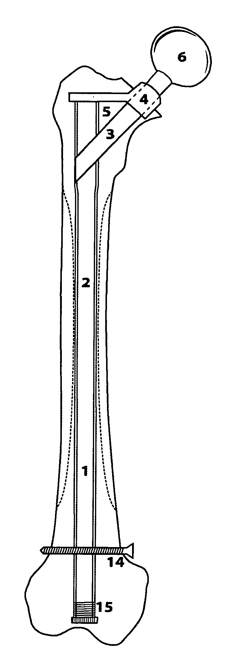 O'Gara femur prosthesis