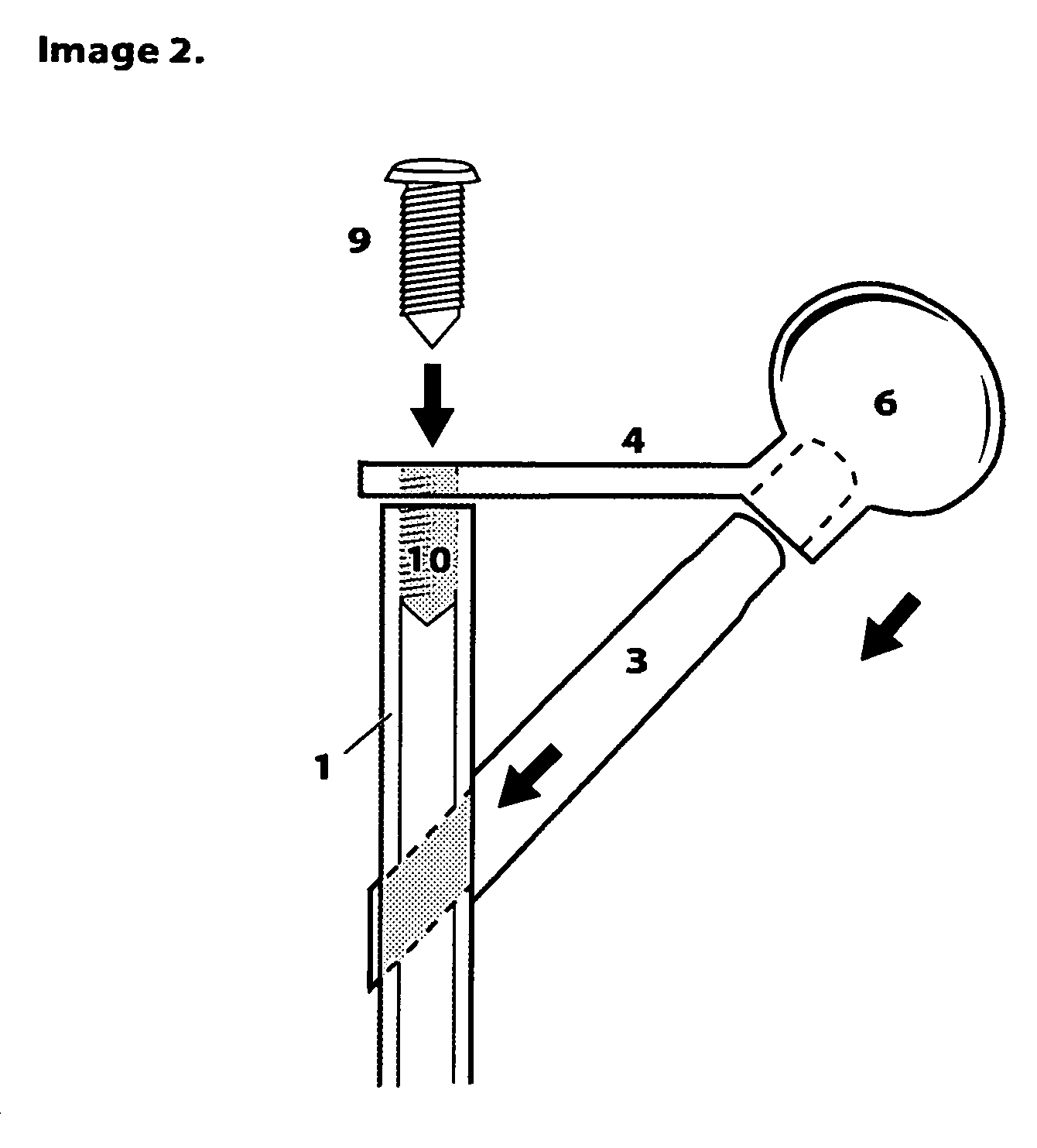 O'Gara femur prosthesis