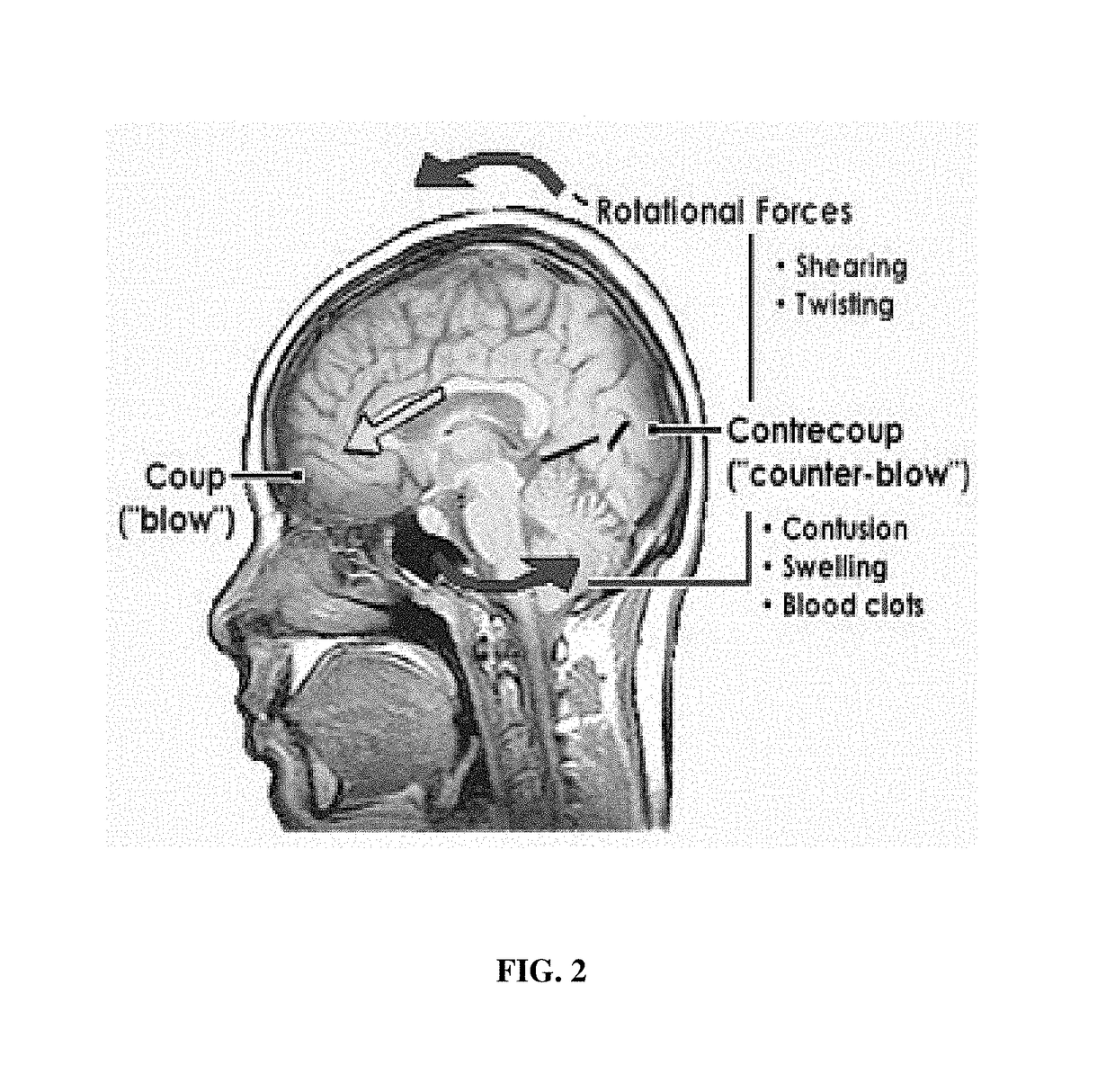 Magnetic football helmet to reduce concussion injuries