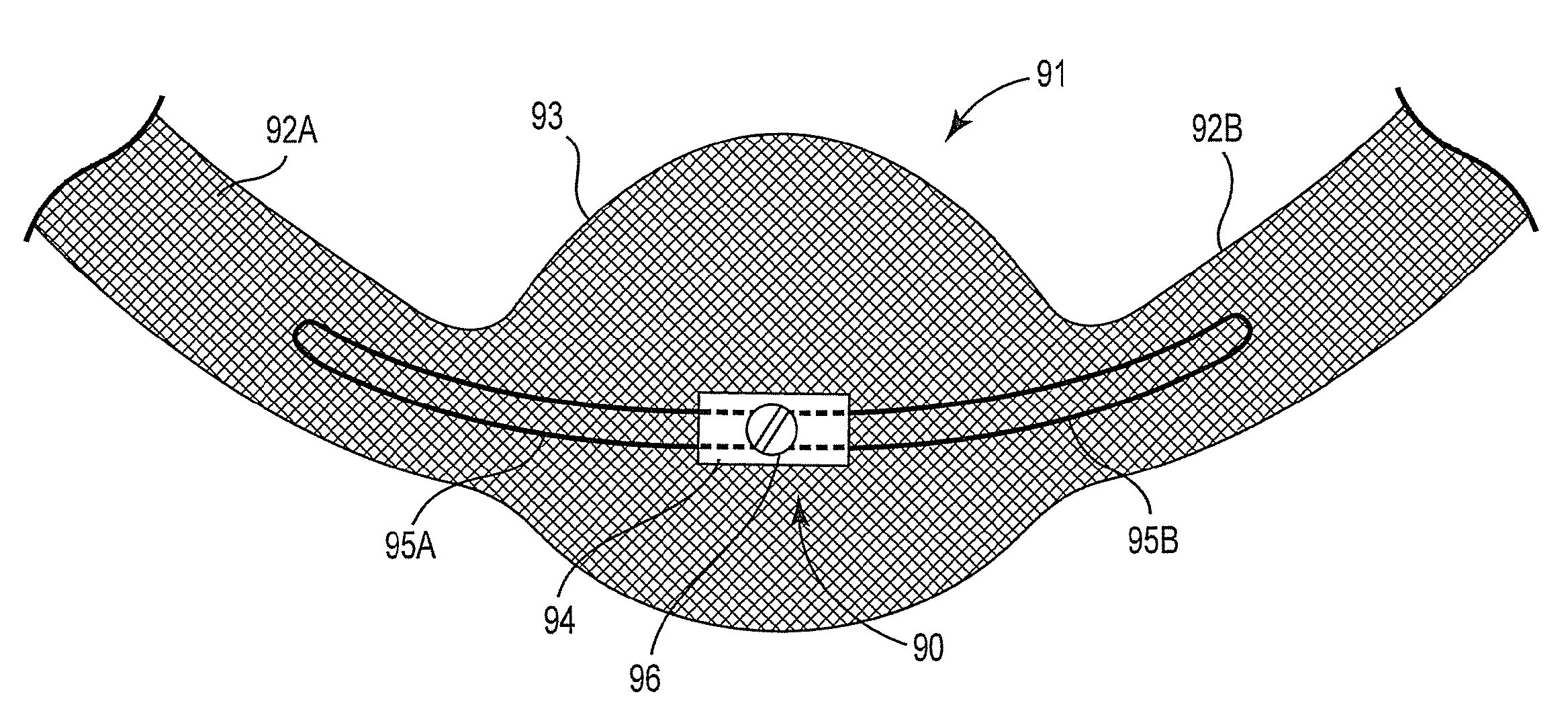 Treatment of anal incontinence and defecatory dysfunction