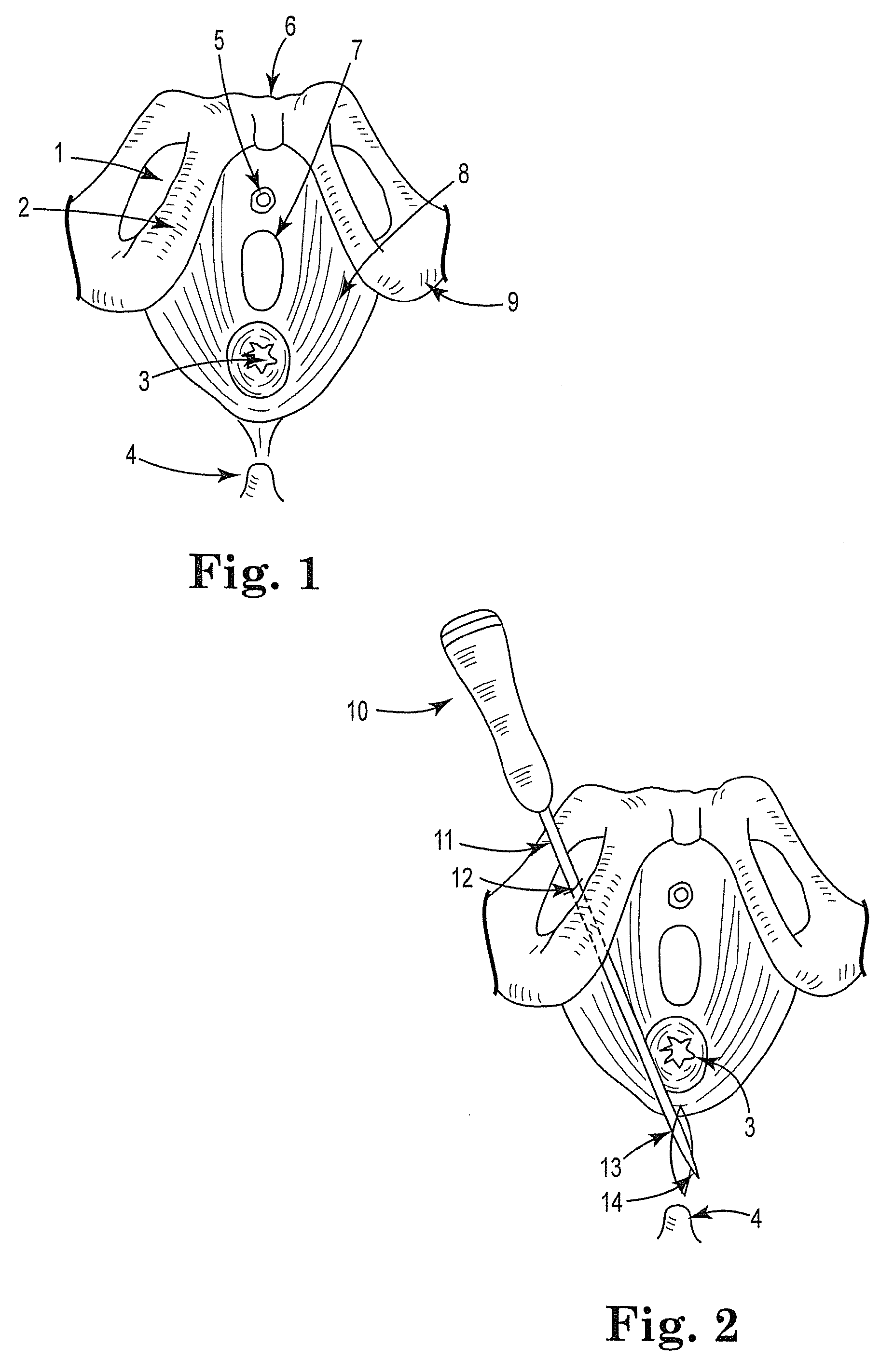 Treatment of anal incontinence and defecatory dysfunction