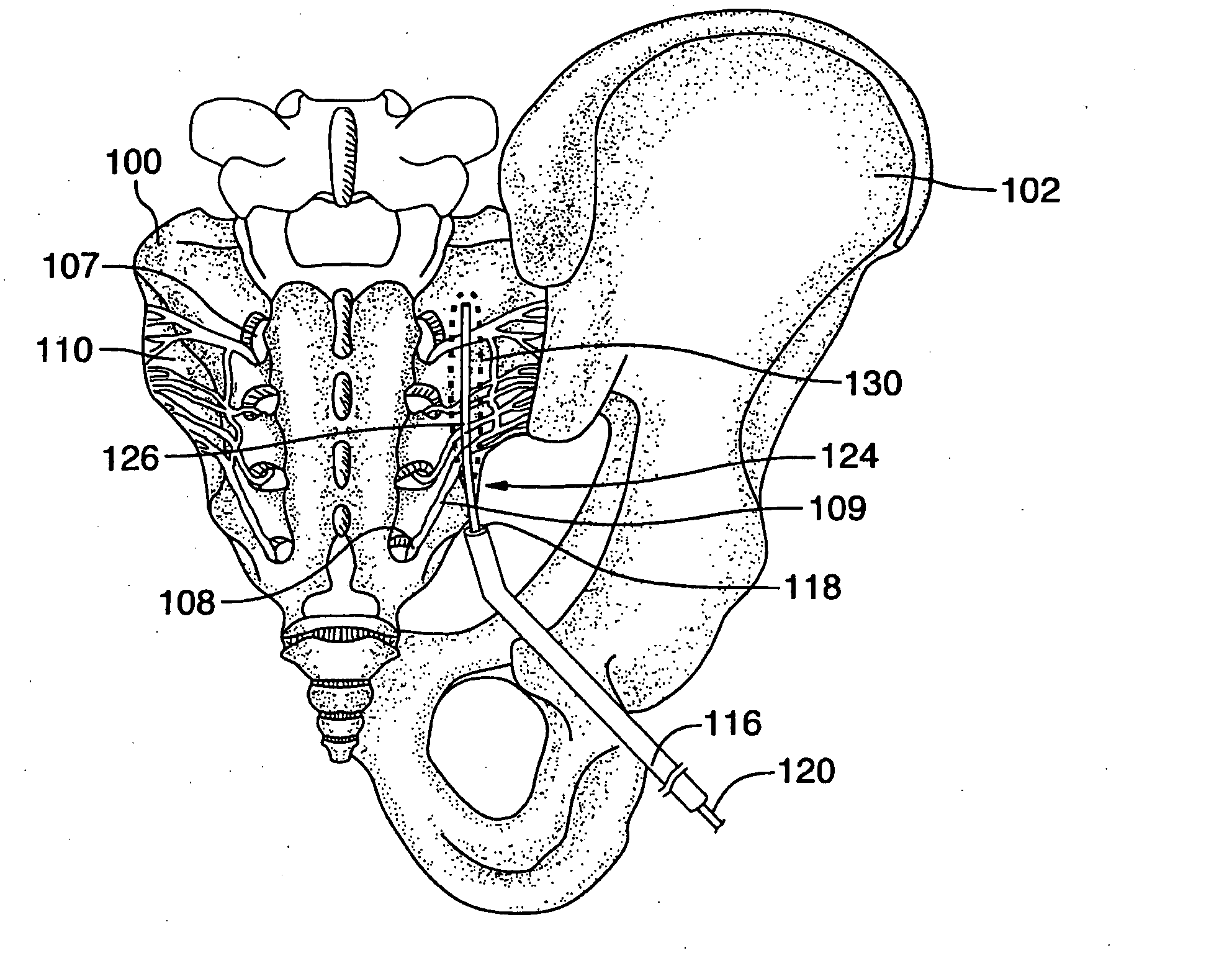 Methods of treating the sacroilac region of a patient's body