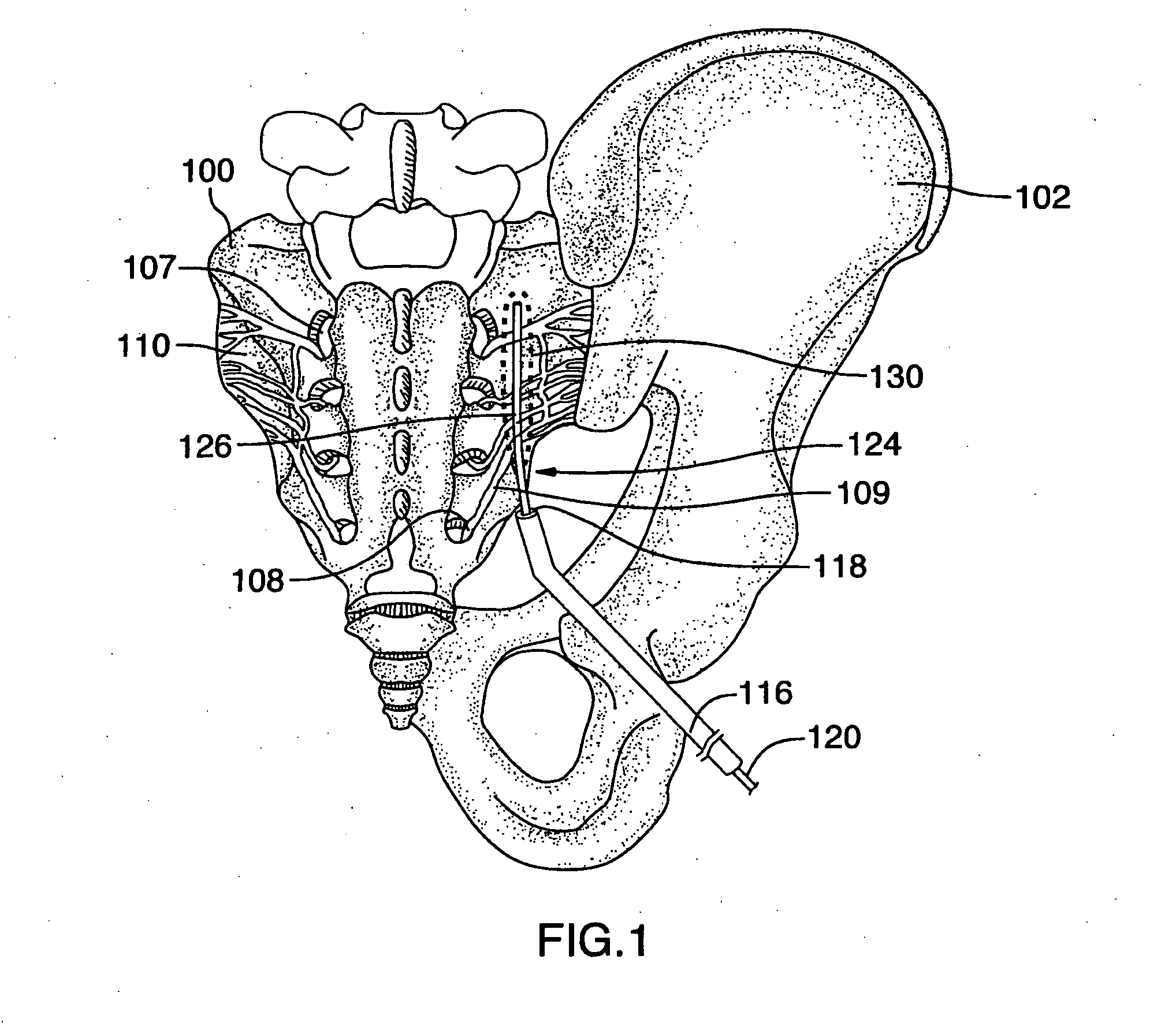 Methods of treating the sacroilac region of a patient's body