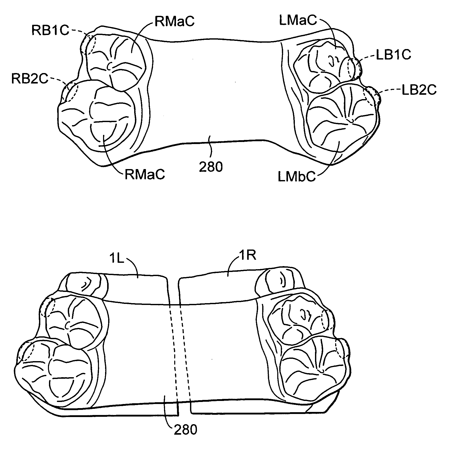 System and method for palatal expansion