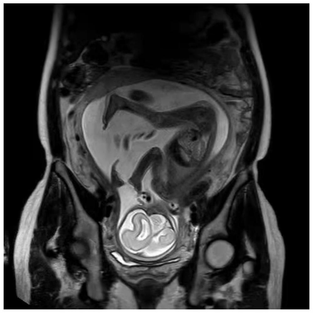 Fetal craniocerebral scanning three-point plane positioning method