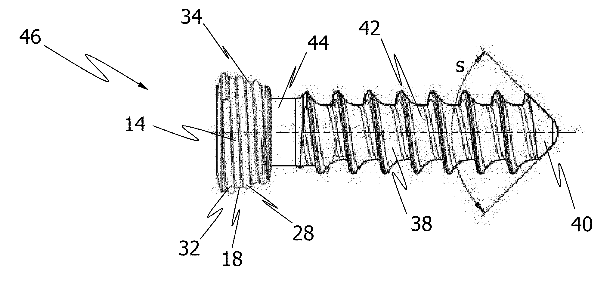 Bone fixation system with curved profile threads