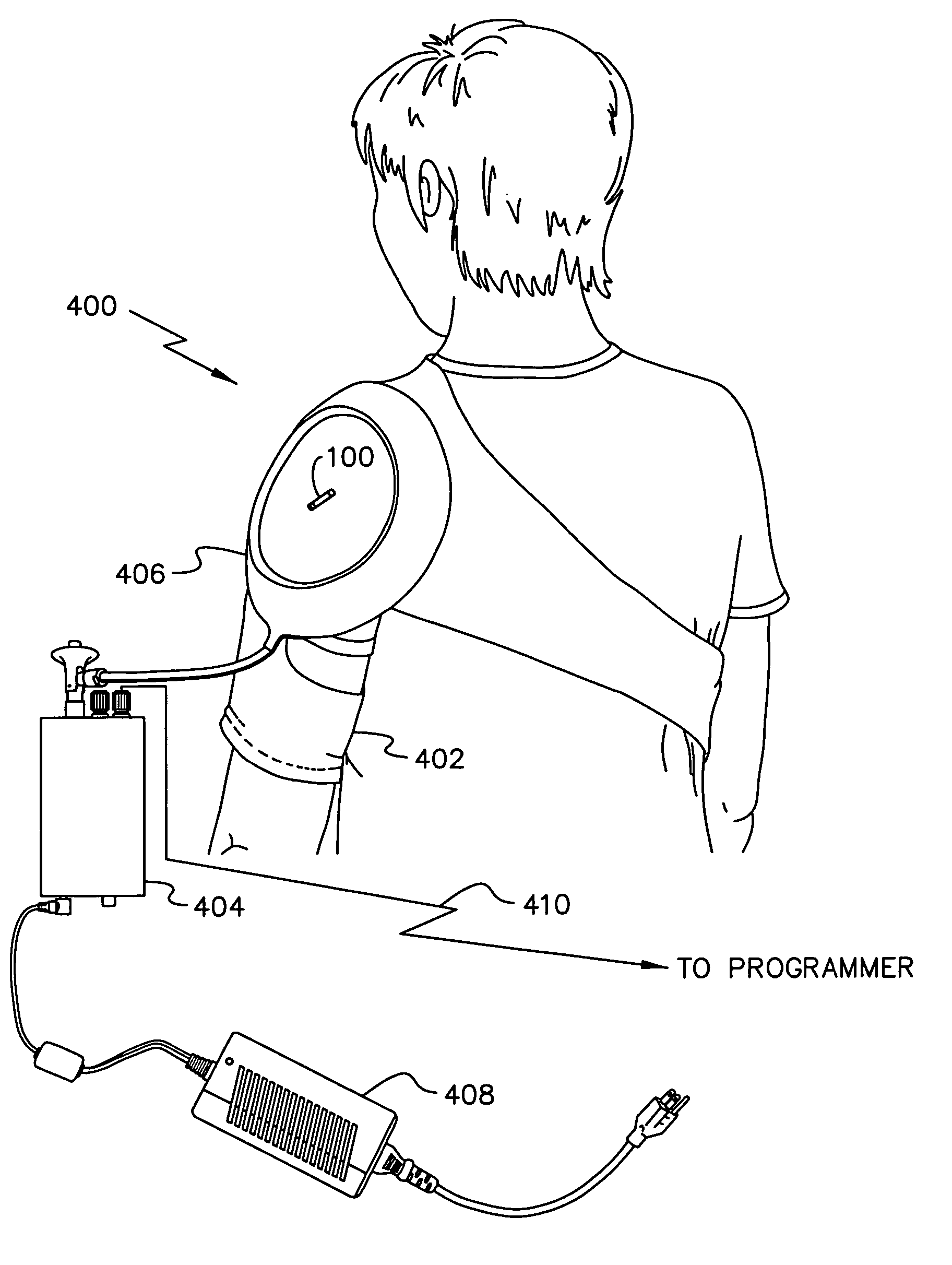 Electrical treatment to treat shoulder subluxation