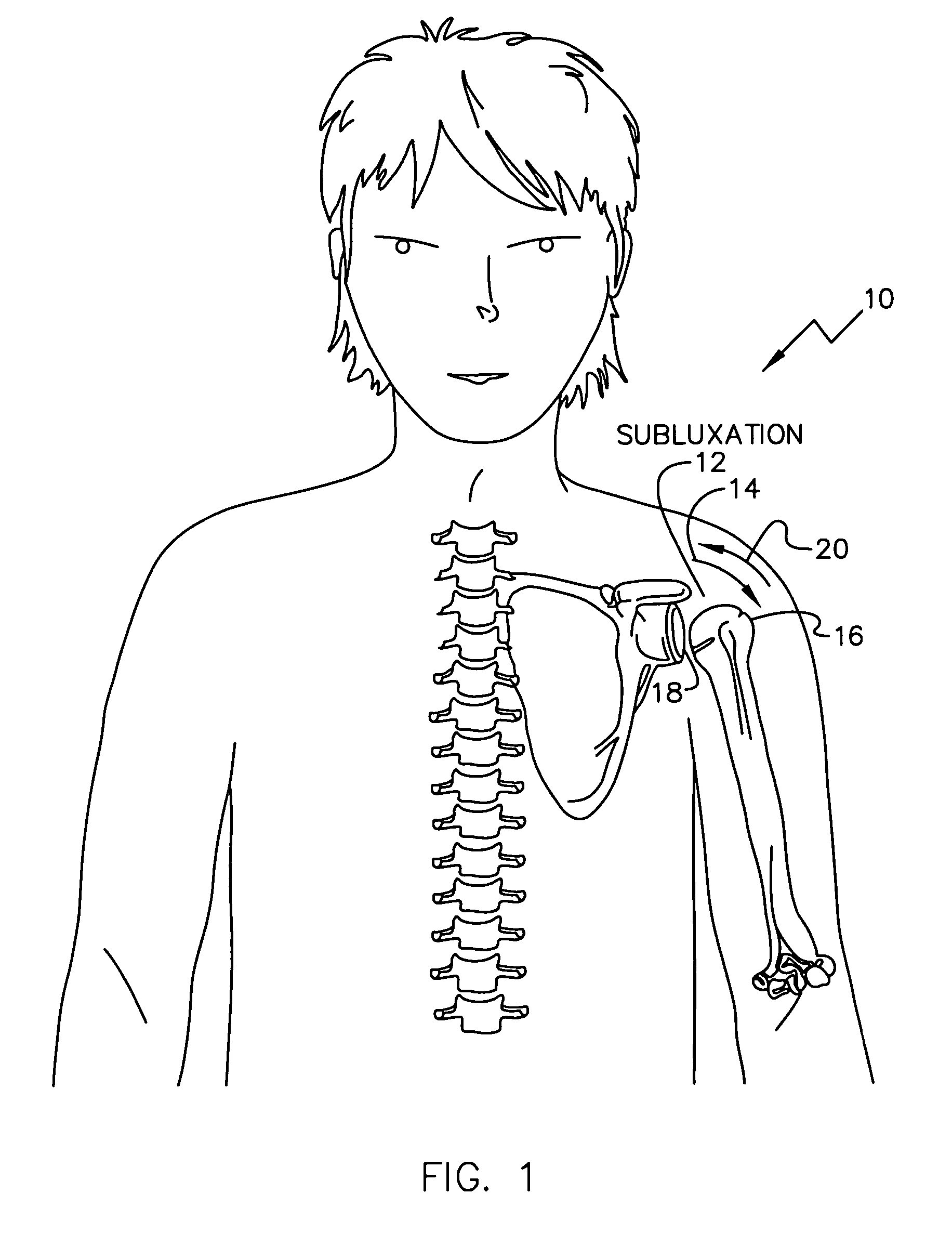 Electrical treatment to treat shoulder subluxation