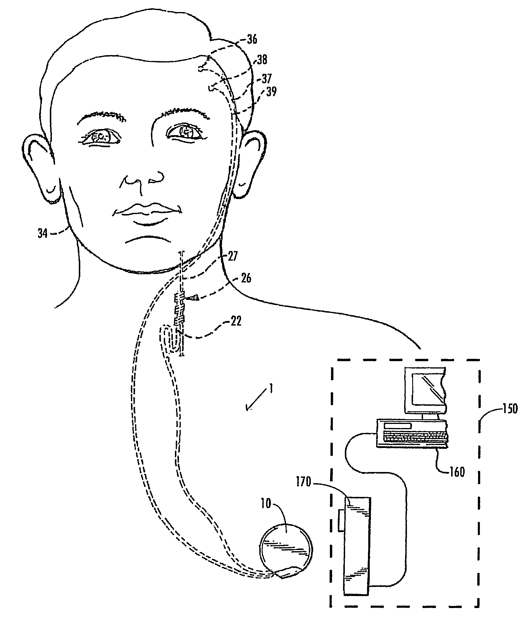 Selective neurostimulation for treating epilepsy