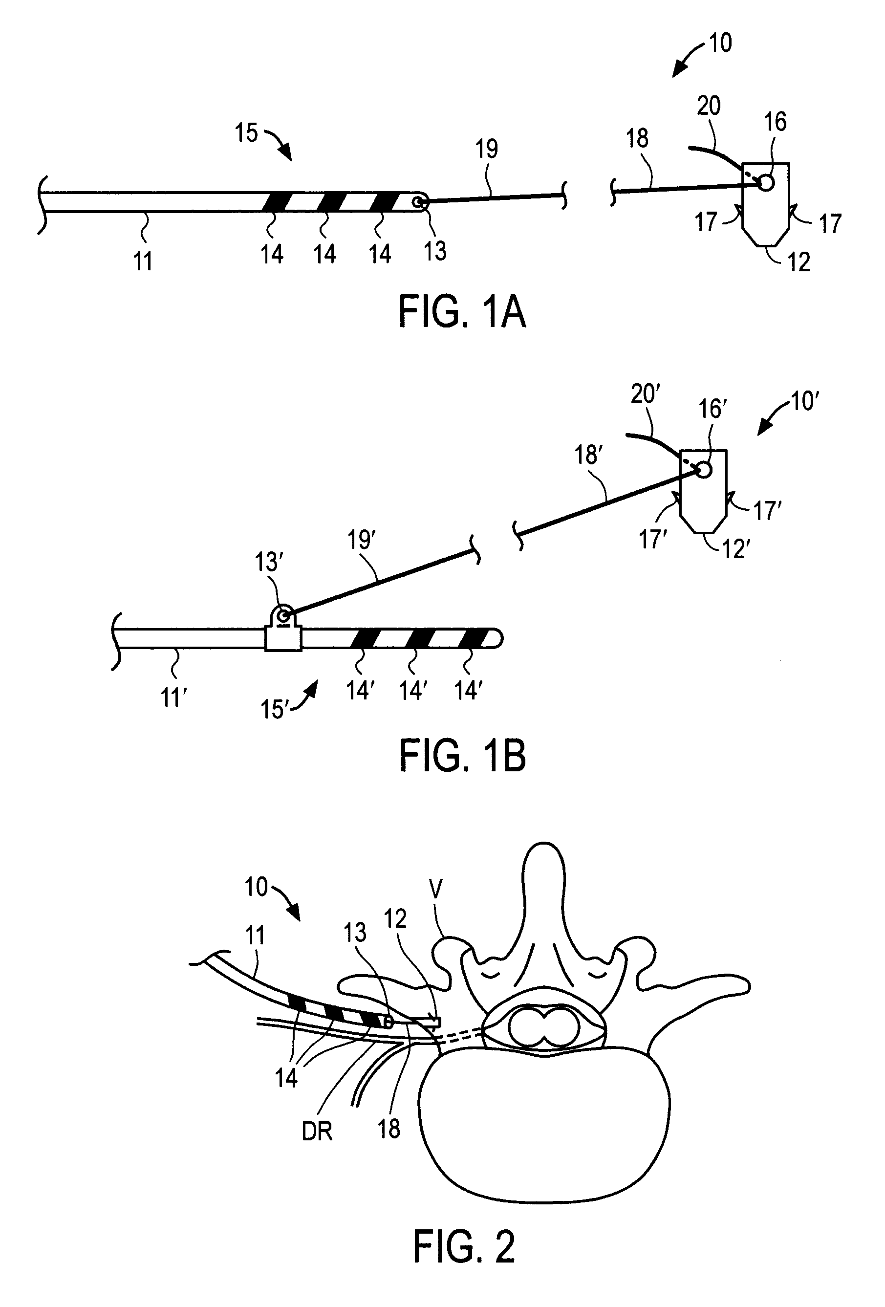 Apparatus and methods for anchoring electrode leads for use with implantable neuromuscular electrical stimulator