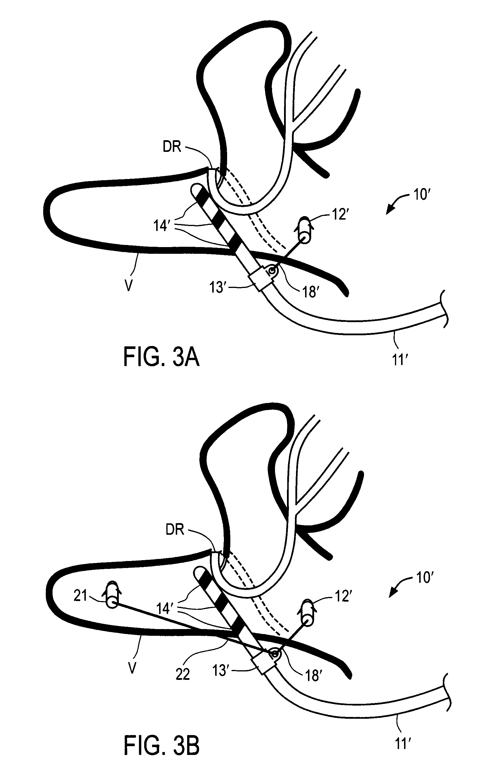 Apparatus and methods for anchoring electrode leads for use with implantable neuromuscular electrical stimulator