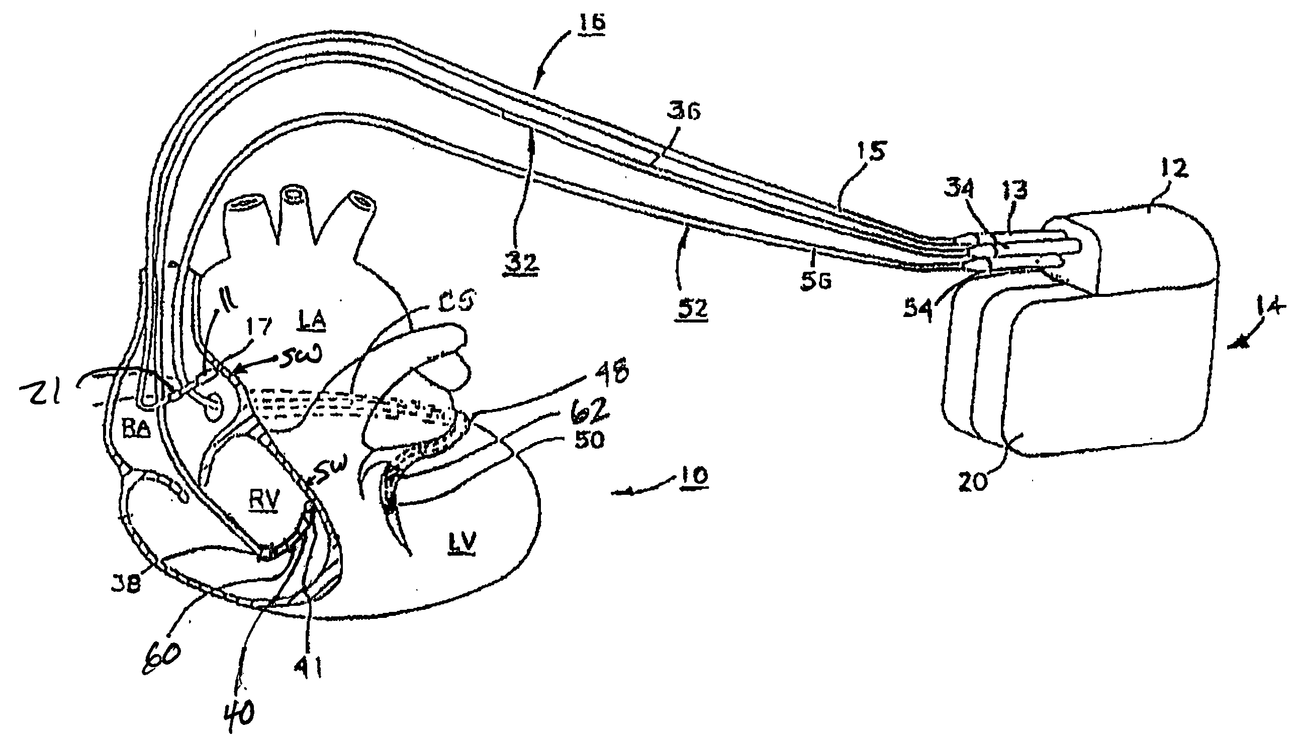 Method of optimizing cardiac resynchronization therapy using sensor signals of septal wall motion