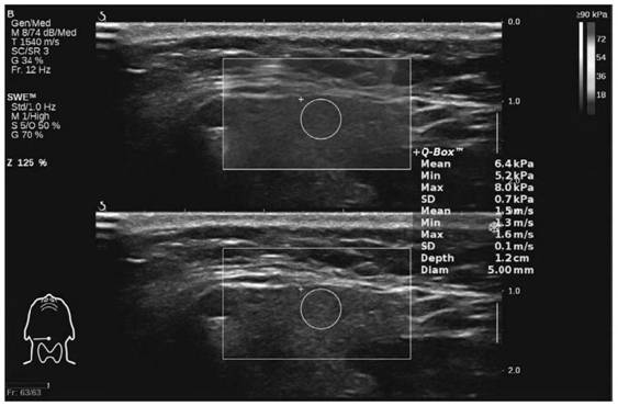 System for evaluating risk that suspected sicca syndrome patient receives lip gland biopsy to obtain positive pathological result