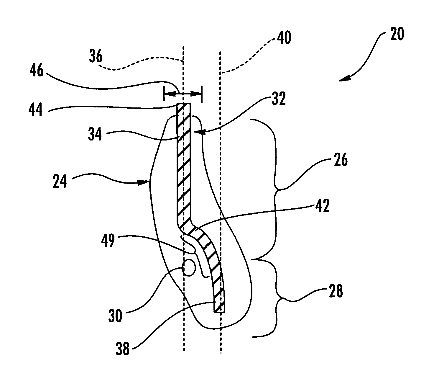 Dental fixture implantation system and associated method