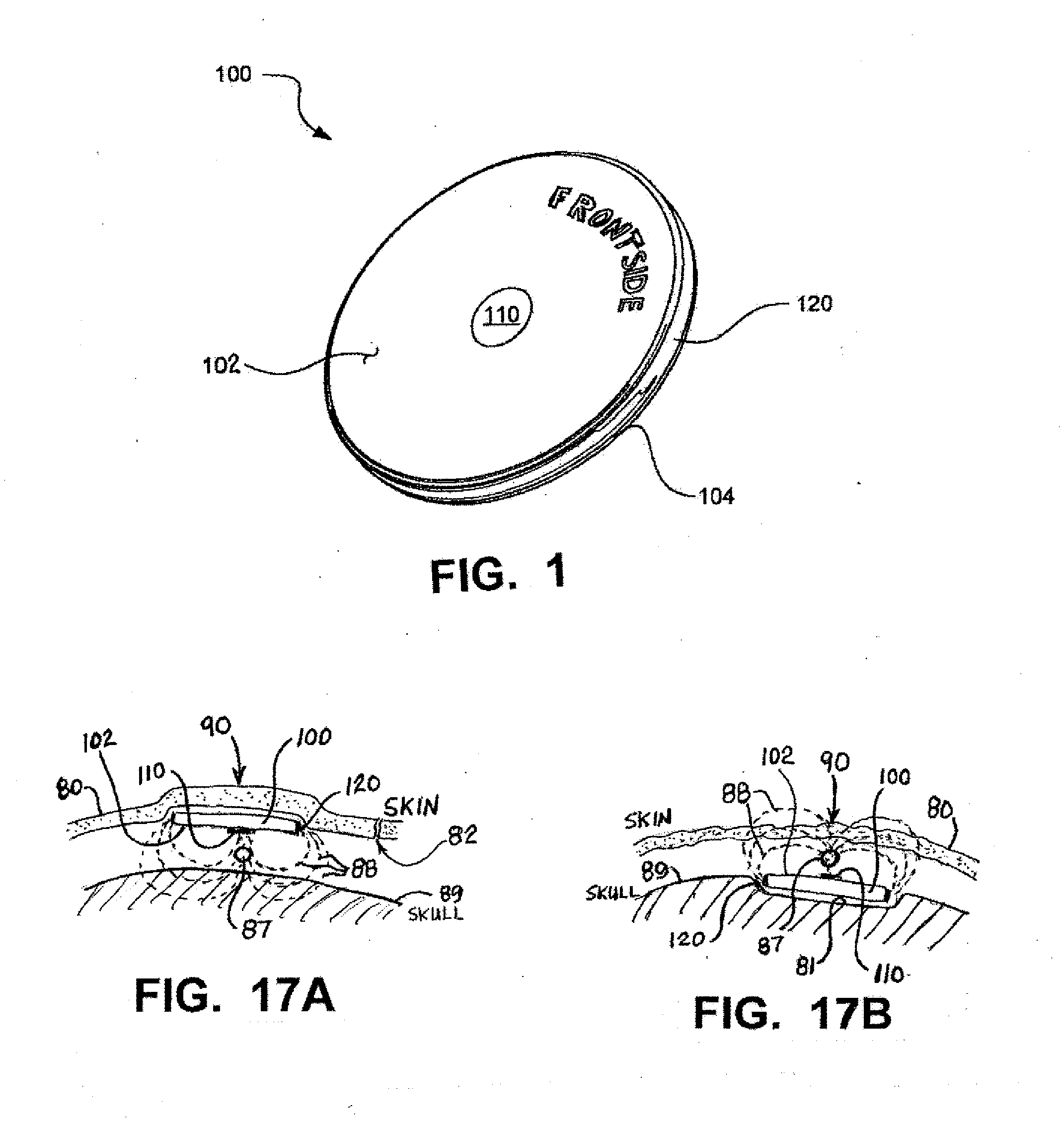 Implantable Electroacupuncture System and Method for Treating Dyslipidemia and Obesity