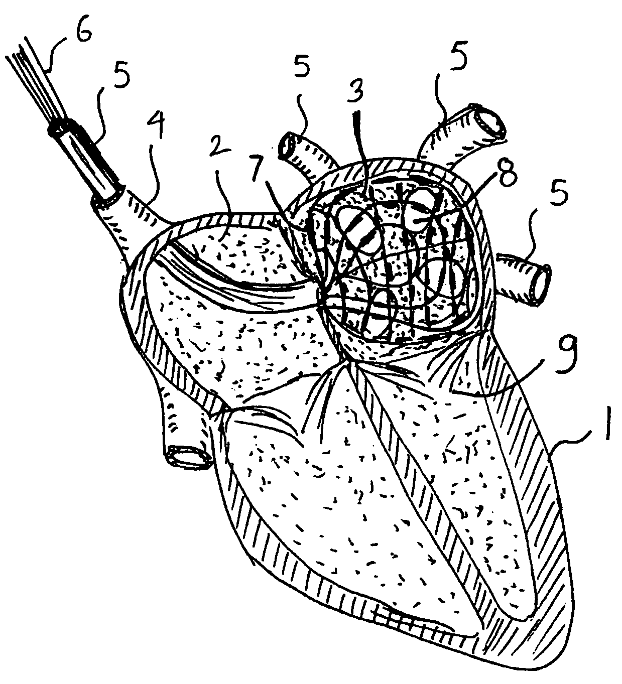 Intra-cardiac mapping and ablation method