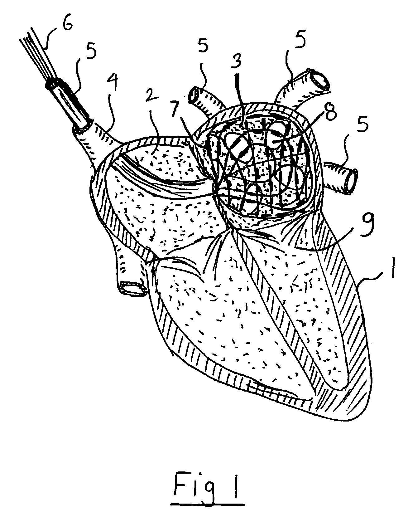 Intra-cardiac mapping and ablation method