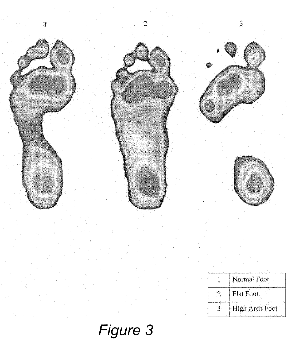 Process of manufacture of customized split insole for diabetic patients