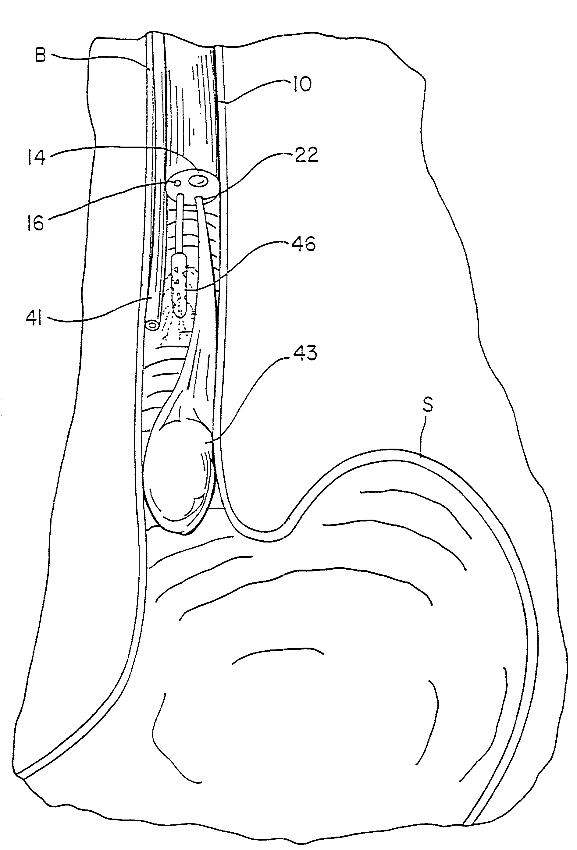 Method and apparatus for cryogenic spray ablation of gastrointestinal mucosa