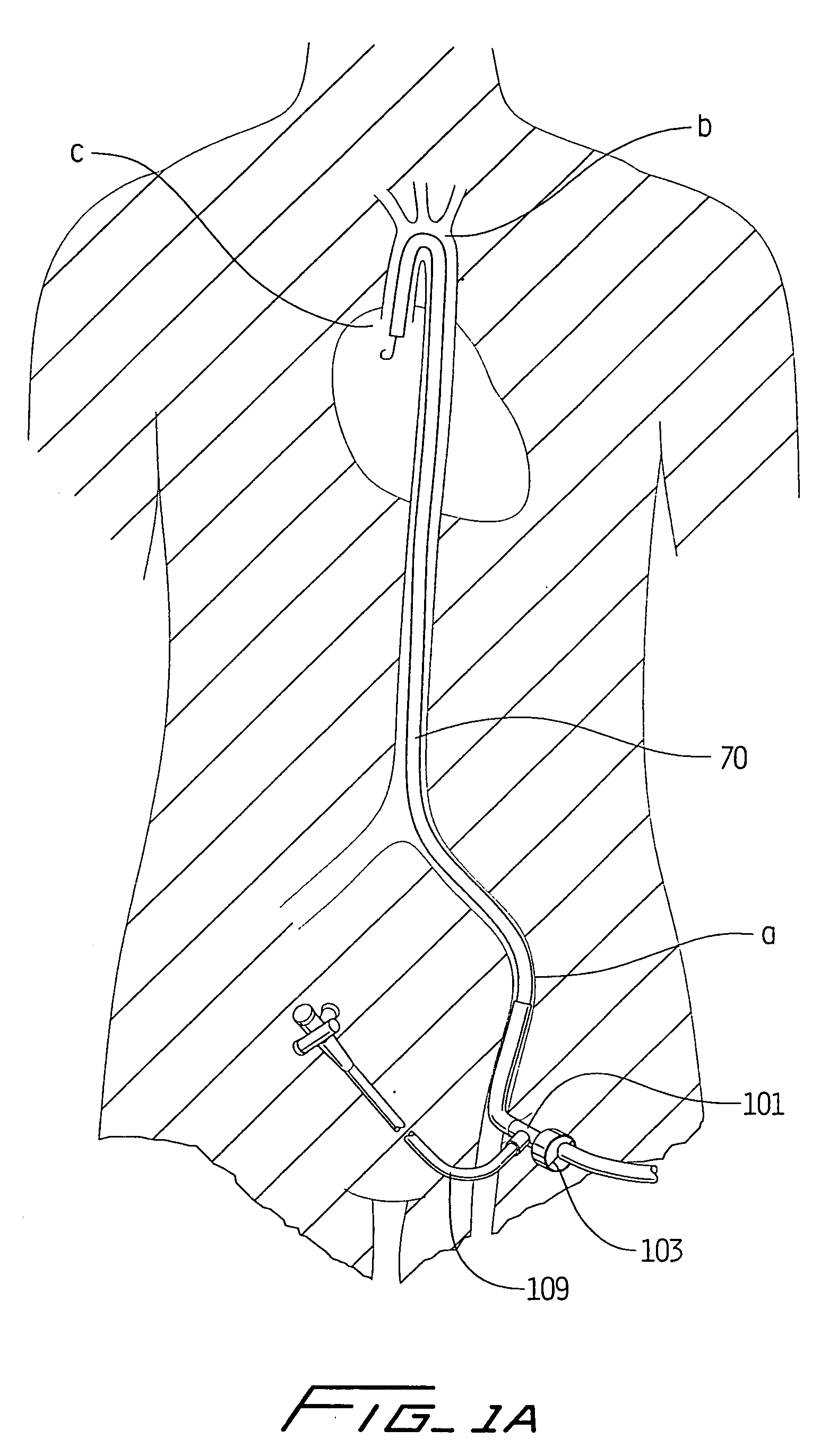 Percutaneous aortic valve