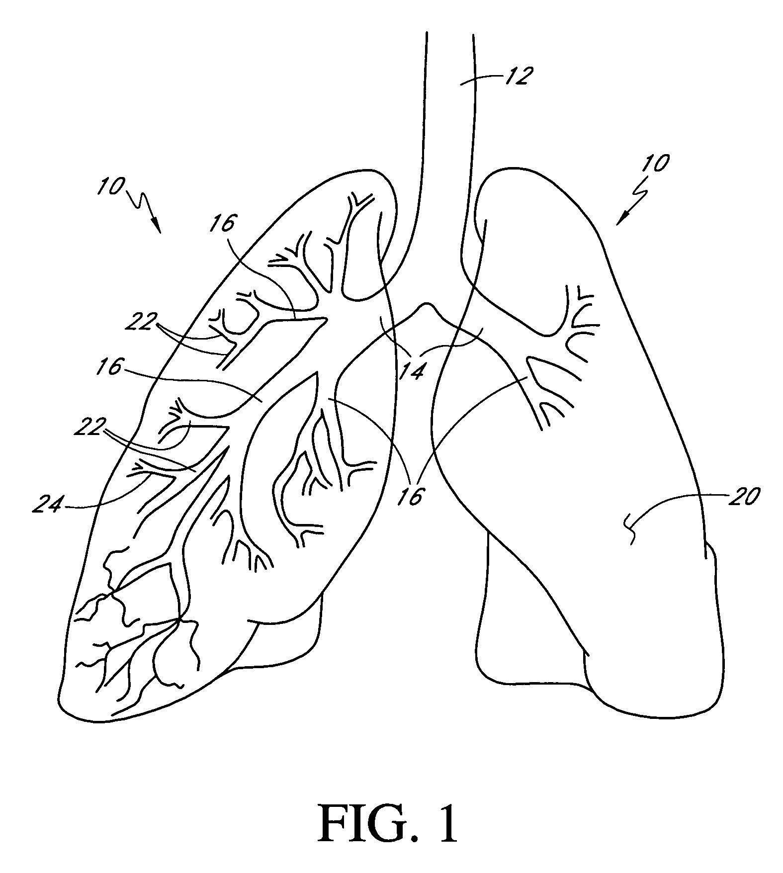 Bronchoscopic repair of air leaks in a lung