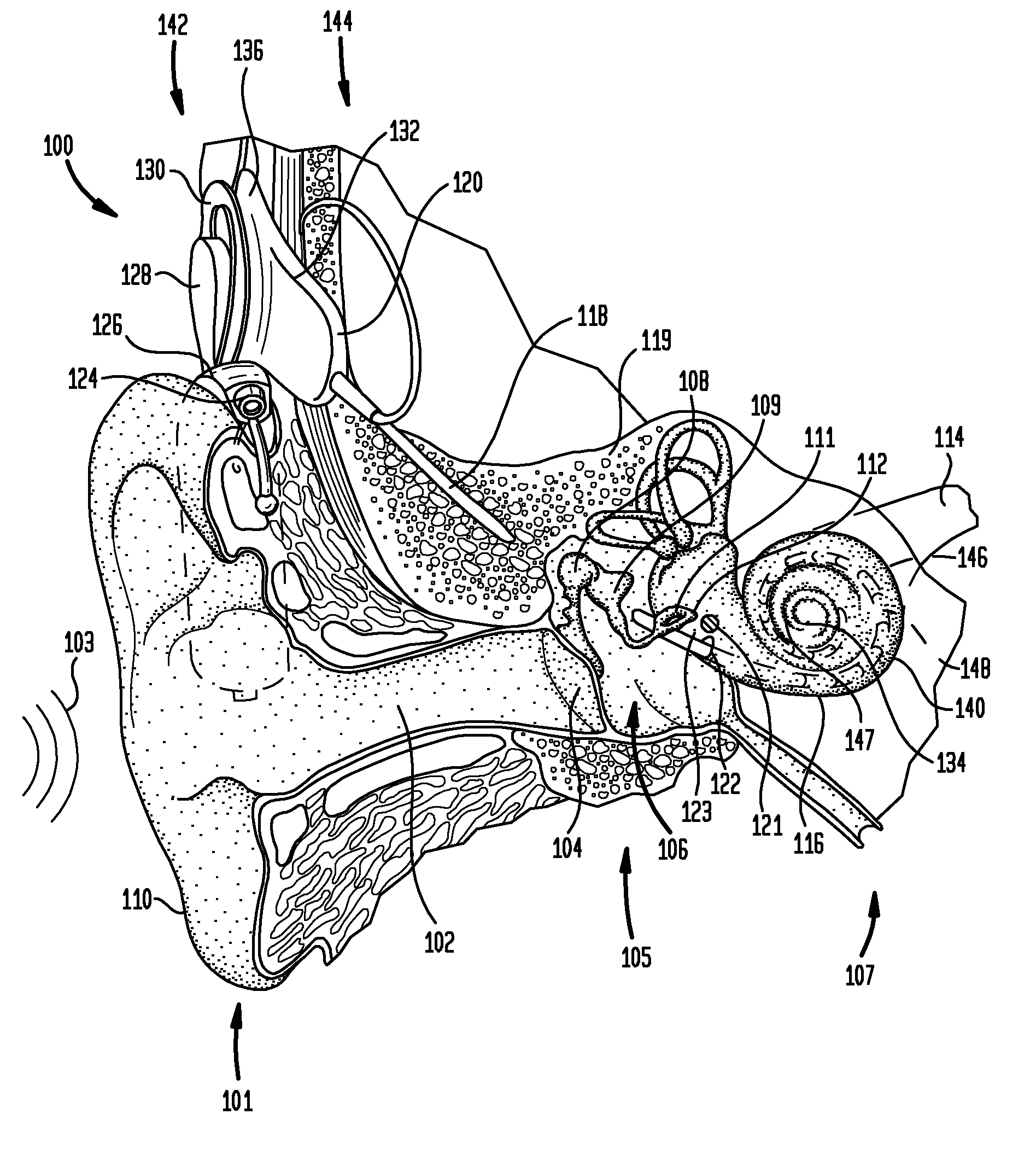 Securing an implanted medical device in a patient