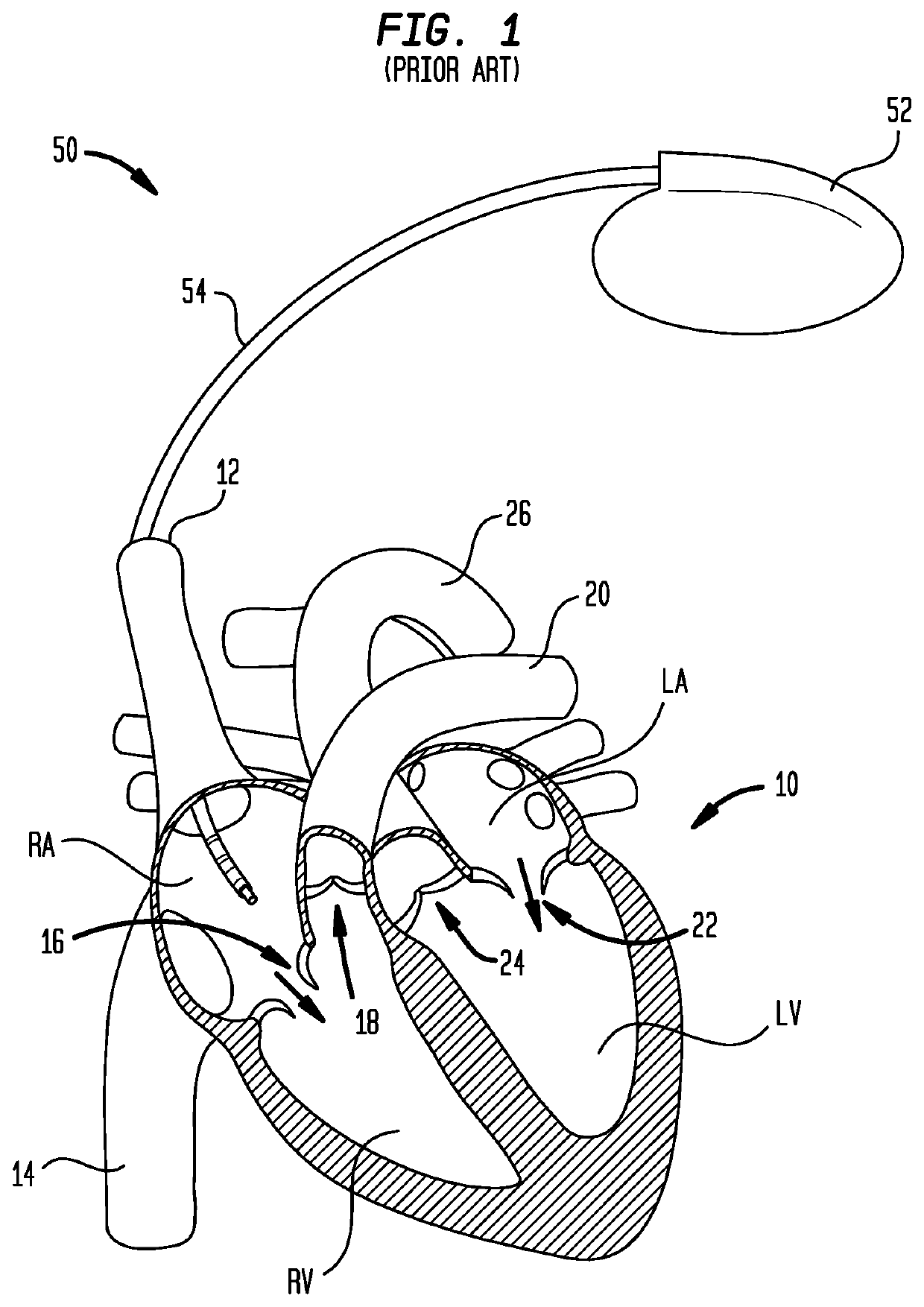 Deflectable Mapping Guide Sheath for His Bundle Pacing