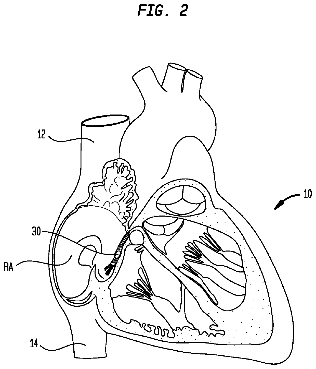 Deflectable Mapping Guide Sheath for His Bundle Pacing