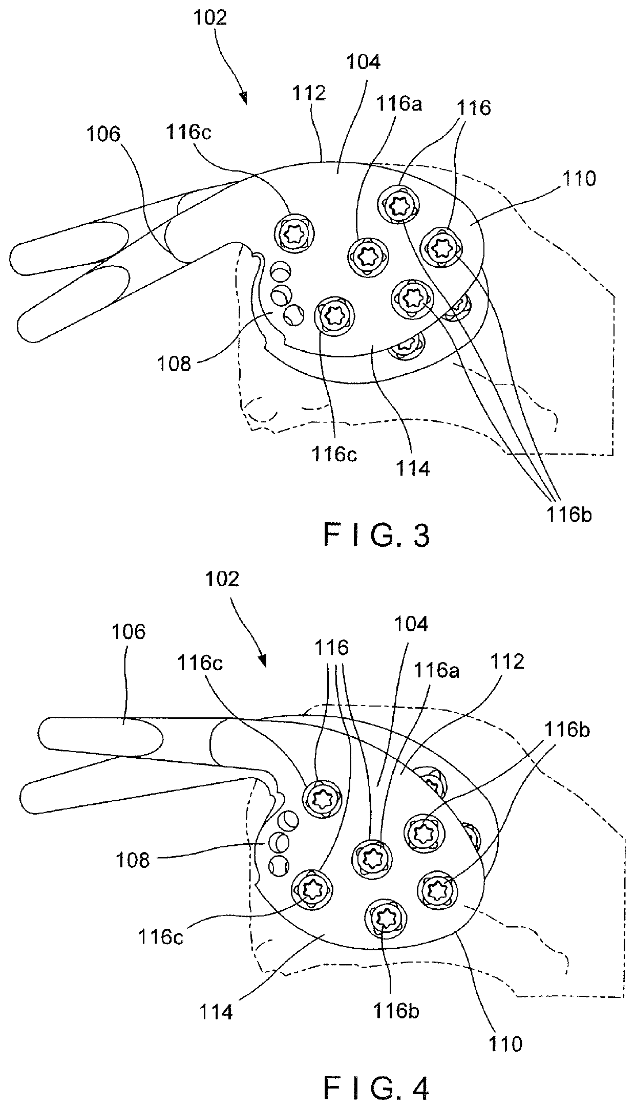 Acromioclavicular hook plate